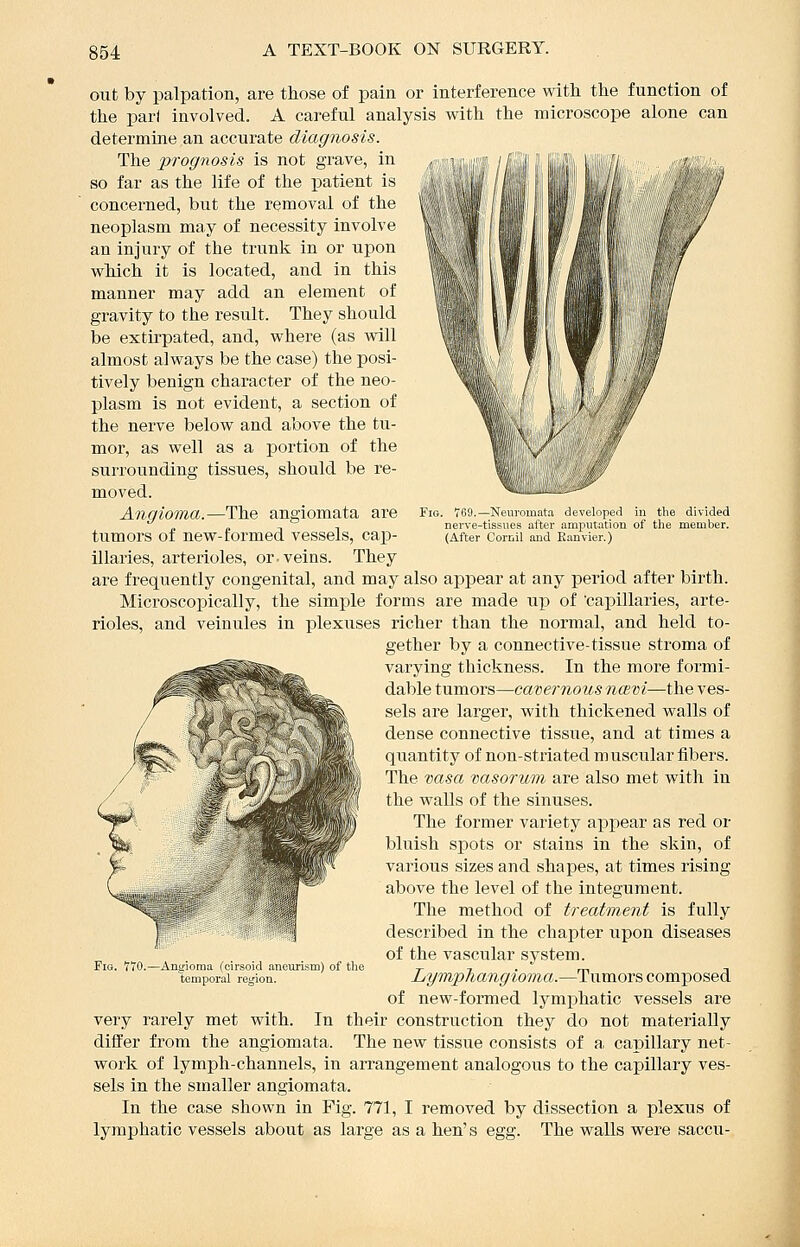 nrr i[i'i}\\ lllil'iil// / 769,—Neuromata developed in the divided nerve-tissues after amputation of tlie member. (After Cornil and Eanvier.) out by palpation, are those of pain or interference with the function of the pari involved. A careful analysis with the microscope alone can determine an accui-ate diagnosis. The prognosis is not grave, in so far as the life of the j)atient is concerned, but the removal of the neoplasm may of necessity involve an injury of the trunk in or upon which it is located, and in this manner may add an element of gravity to the result. They should be extirpated, and, where (as will almost always be the case) the posi- tively benign character of the neo- plasm is not evident, a section of the nerve below and above the tu- mor, as well as a portion of the surrounding tissues, should be re- moved. Angioma.—The angiomata are tumors of new-formed vessels, cap- illaries, arterioles, or. veins. They are frequently congenital, and may also appear at any period after birth. Microscopically, the simple forms are made up of 'capillaries, arte- rioles, and veinules in plexuses richer than the normal, and held to- gether by a connective-tissue stroma of varying thickness. In the more formi- dable tumors—cavernous ncBvi—the ves- sels are larger, with thickened walls of dense connective tissue, and at times a quantity of non-striated muscular fibers. The vasa vasorum are also met with in the walls of the sinuses. The former variety appear as red or bluish spots or stains in the skin, of various sizes and shapes, at times rising above the level of the integument. The method of treatment is fully described in the chapter upon diseases of the vascular system. Lymphangioma.—Tumors composed of new-formed lymphatic vessels are very rarely met with. In their construction they do not materially differ from the angiomata. The new tissue consists of a, capillary net- work of lymph-channels, in arrangement analogoiis to the capillary ves- sels in the smaller angiomata. In the case shown in Fig. 771, I removed by dissection a plexus of lymphatic vessels about as large as a hen's egg. The walls were saccu- Fia. T70.—Angioma (cirsoid aneurism) of the temporal region.