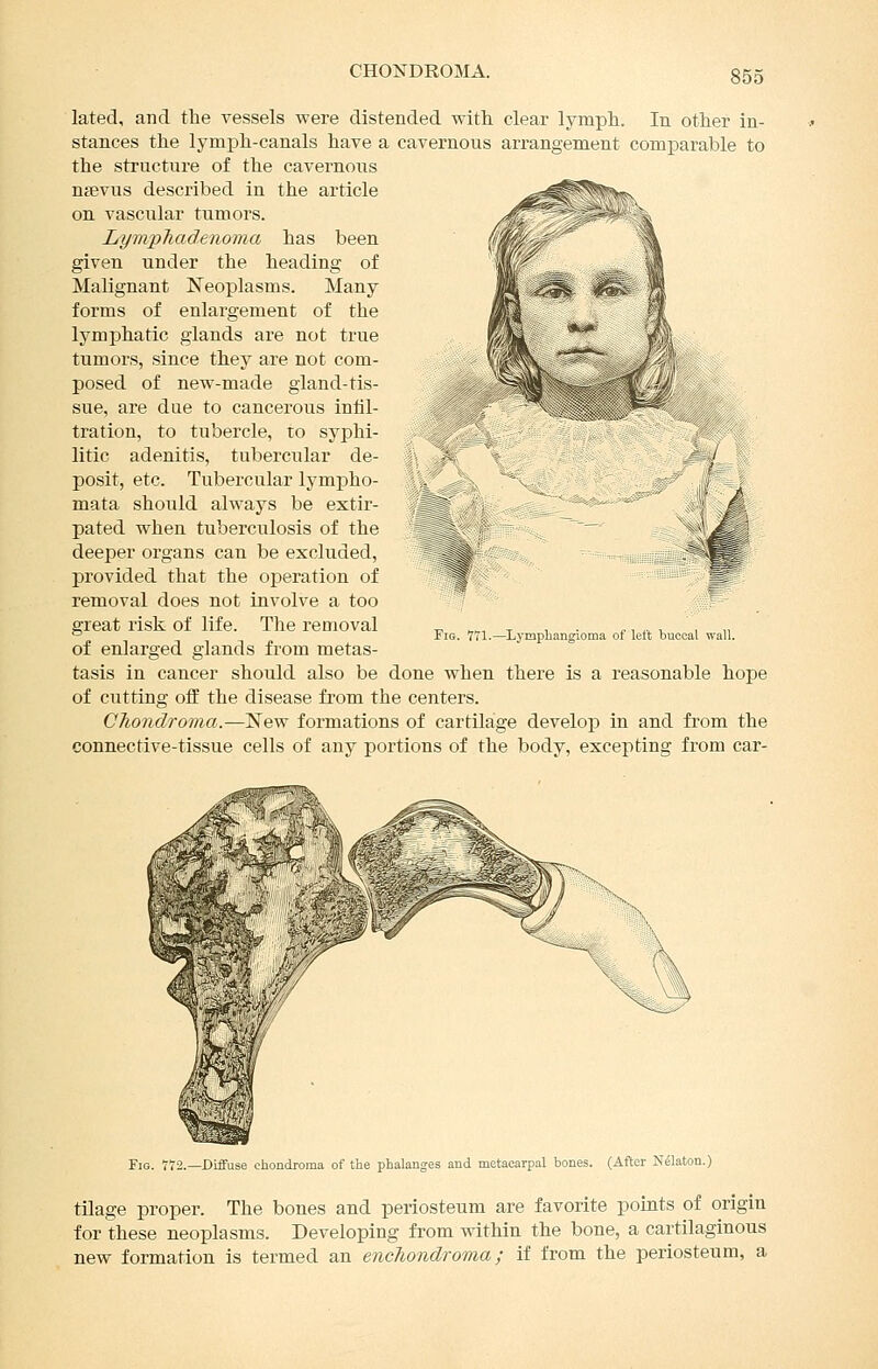 CHONDROMA. lated, and the vessels were distended with clear lymph. In other in- stances the lymph-canals have a cavernous arrangement comparable to the structure of the cavernous ngevus described in the article on vascular tumors. LympTiadenoma has been given under the heading of Malignant Neoplasms. Many forms of enlargement of the lymphatic glands are not true tumors, since they are not com- posed of new-made gland-tis- sue, are due to cancerous inlil- tration, to tubercle, to syphi- litic adenitis, tubercular de- posit, etc. Tubercular lympho- mata should always be extir- pated when tuberculosis of the deeper organs can be excluded, provided that the operation of removal does not involve a too great risk of life. The removal of enlarged glands from metas- tasis in cancer should also be done when there is a reasonable hope of cutting ofE the disease from the centers. Chondroma.—New formations of cartilage develop in and from the connective-tissue cells of any portions of the body, excepting from car- FiG. 771.—Lymphangioma of left buccal wall. Fig. 772.—Diffuse chondroma of the phalanges and metacarpal bones. (After N^laton.) tilage proper. The bones and periosteum are favorite points of origin for these neoplasms. Developing from within the bone, a cartilaginous new formation is termed an encJiondroma; if from the periosteum, a