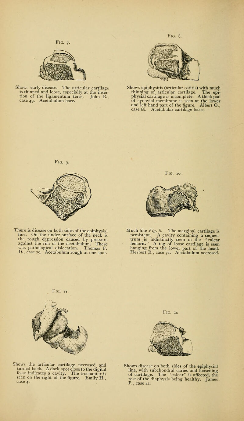 Fig. 7. Shows early disease. The articular cartilage is thinned and loose, especially at the inser- tion of the ligamentum teres. John B., case 49. Acetabulum bare. Shows epiphysitis (articular ostitis) with much thinning of articular cartilage. The epi- physial cartilage is incomplete. A thick pad of synovial membrane is seen at the lower and left hand part of the figure. Albert O., case 68. Acetabular cartilage loose. Fig. 9. ,^i:>- There is disease on both sides of the epiphysial line. On the under surface of the neck is the rough depression caused by pressure against the rim of the acetabulum. There was pathological dislocation. Thomas F. D., case 79. Acetabulum rough at one spot. Much like Fig. 6. The marginal cartilage is persistent. A cavity containing a seques- trum is indistinctly seen in the calcar femoris. A tag of loose cartilage is seen hanging from the lower part of the head. Herbert B., case 71. Acetabulum necrosed. Fig. 12 Shows the articular cartilage necrosed and turned back. A dark spot close to the digital fossa indicates a cavity. The trochanter is seen on the right of the figure. Emily H., case 4. Shows disease on both sides of the epiphysial line, with subchondral caries and loosening of cartilage. The calcar is affected, the rest of the diaphysis being healthy. James P., case 41.
