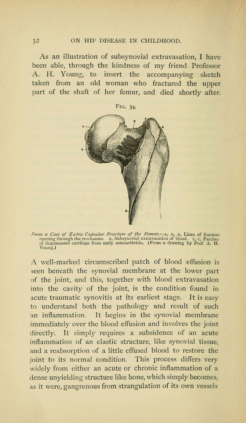 As an illustration of subsynovial extravasation, I have been able, through the kindness of my friend Professor A. H. Young, to insert the accompanying sketch taken from an old woman who fractured the upper part of the shaft of her femur, and died shortly after. Fig. 34. From a Case of Extra Capsular Fracture of the Femur— a, a, a, Lines of fracture running through the trochanter. B, Subsynovial_ extravasation of blood, c, c, Patches of degenerated cartilage from early osteoarthritis. (From a drawing by Prof. A. H. Young.) A well-marked circumscribed patch of blood effusion is seen beneath the synovial membrane at the lower part of the joint, and this, together with blood extravasation into the cavity of the joint, is the condition found in acute traumatic synovitis at its earliest stage. It is easy to understand both the pathology and result of such an inflammation. It begins in the synovial membrane immediately over the blood effusion and involves the joint directly. It simply requires a subsidence of an acute inflammation of an elastic structure, like synovial tissue, and a reabsorption of a little effused blood to restore the joint to its normal condition, This process differs very widely from either an acute or chronic inflammation of a dense unyielding structure like bone, which simply becomes, as it were, gangrenous from strangulation of its own vessels