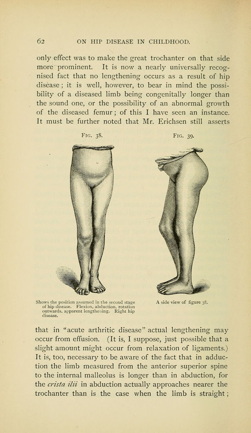 only effect was to make the great trochanter on that side more prominent. It is now a nearly universally recog- nised fact that no lengthening occurs as a result of hip disease ; it is well, however, to bear in mind the possi- bility of a diseased limb being congenitally longer than the sound one, or the possibility of an abnormal growth of the diseased femur; of this I have seen an instance. It must be further noted that Mr. Erichsen still asserts Fig. 38. Fig. 39. Shows the position assumed in the second stage of hip disease. Flexion, abduction, rotation outwards, apparent lengthening. Right hip disease. A side view of figure 38. that in acute arthritic disease actual lengthening may occur from effusion. (It is, I suppose, just possible that a slight amount might occur from relaxation of ligaments.) It is, too, necessary to be aware of the fact that in adduc- tion the limb measured from the anterior superior spine to the internal malleolus is longer than in abduction, for the crista ilii in abduction actually approaches nearer the trochanter than is the case when the limb is straight ;