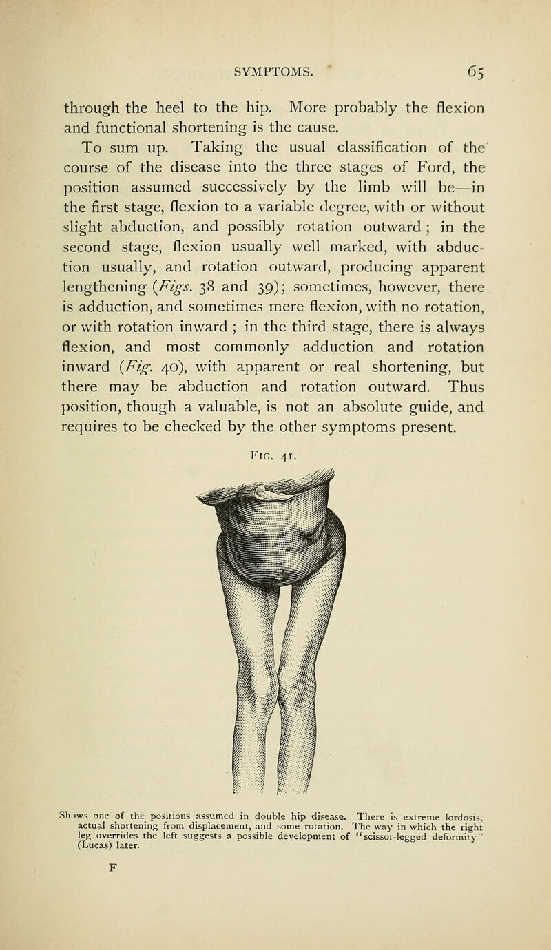 through the heel to the hip. More probably the flexion and functional shortening is the cause. To sum up. Taking the usual classification of the' course of the disease into the three stages of Ford, the position assumed successively by the limb will be—in the first stage, flexion to a variable degree, with or without slight abduction, and possibly rotation outward ; in the second stage, flexion usually well marked, with abduc- tion usually, and rotation outward, producing apparent lengthening {Figs. 38 and 39); sometimes, however, there is adduction, and sometimes mere flexion, with no rotation, or with rotation inward ; in the third stage, there is always flexion, and most commonly adduction and rotation inward {Fig. 40), with apparent or real shortening, but there may be abduction and rotation outward. Thus position, though a valuable, is not an absolute guide, and requires to be checked by the other symptoms present. Fig. 41. Shows one of the positions assumed in double hip disease. There is extreme lordosis, actual shortening from displacement, and some rotation. The way in which the right leg overrides the left suggests a possible development of scissor-legged deformity (Lucas) later.