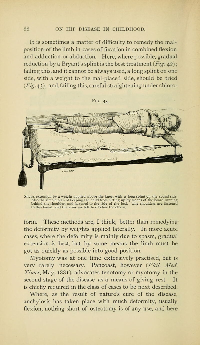 It is sometimes a matter of difficulty to remedy the mal- position of the limb in cases of fixation in combined flexion and adduction or abduction. Here, where possible, gradual reduction by a Bryant's splint is the best treatment {Fig. 42); failing this, and it cannot be always used, a long splint on one side, with a weight to the mal-placed side, should be tried {Fig. 43); and,failing this,careful straightening under chloro- Fig. 43. Shows extension by a weight applied above the knee, with a long splint on the sound side. Also the simple plan of keeping the child from sitting up by means of the board running behind the shoulders and fastened to the side of the bed. The shoulders are fastened to this board, and the arms are left free below the elbow. form. These methods are, I think, better than remedying the deformity by weights applied laterally. In more acute cases, where the deformity is mainly due to spasm, gradual extension is best, but by some means the limb must be got as quickly as possible into good position. Myotomy was at one time extensively practised, but is very rarely necessary. Pancoast, however {Phil. Med. Tillies, May, 1881), advocates tenotomy or myotomy in the second stage of the disease as a means of giving rest. It is chiefly required in the class of cases to be next described. Where, as the result of nature's cure of the disease, anchylosis has taken place with much deformity, usually flexion, nothing short of osteotomy is of any use, and here