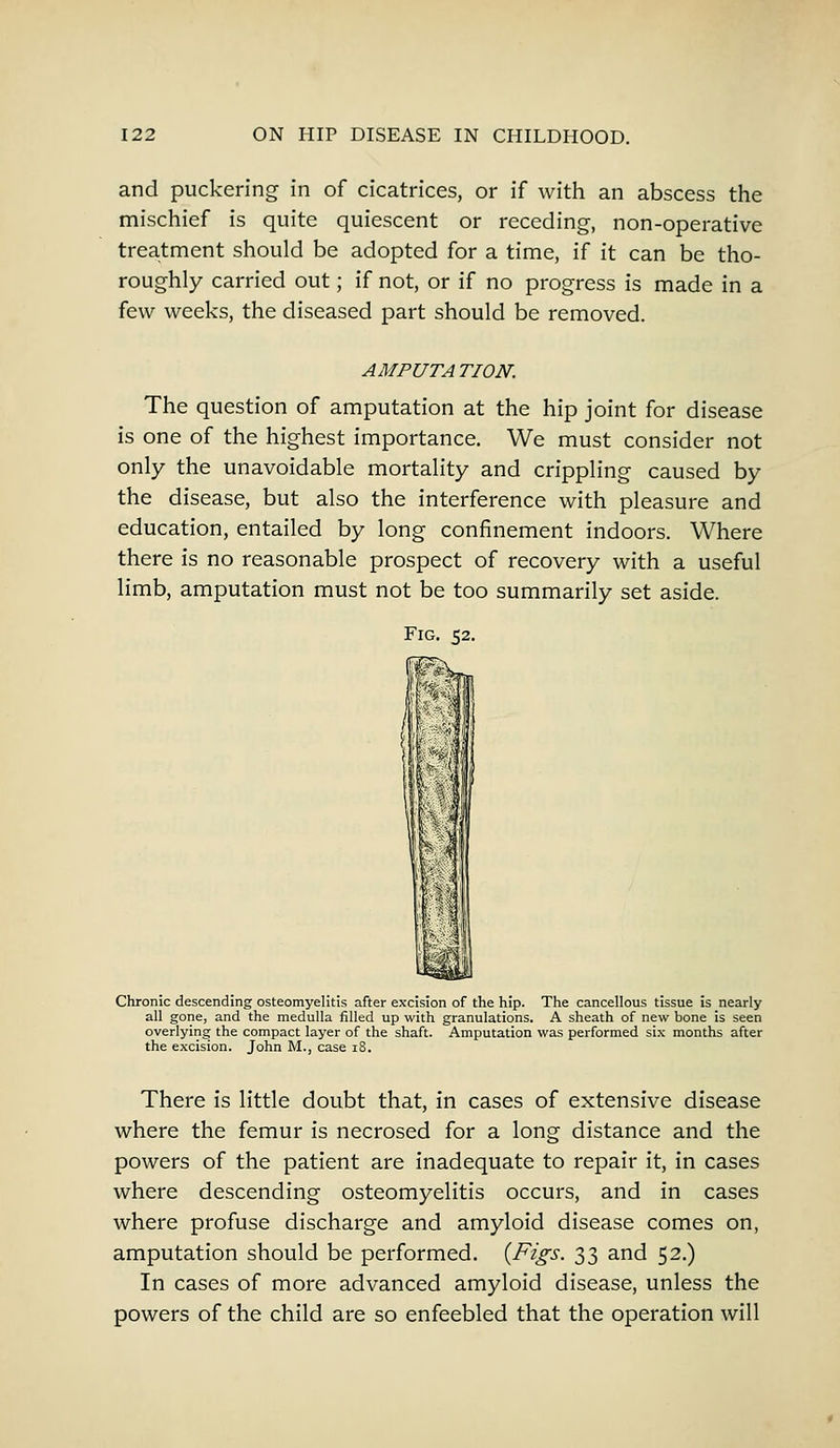 and puckering in of cicatrices, or if with an abscess the mischief is quite quiescent or receding, non-operative treatment should be adopted for a time, if it can be tho- roughly carried out; if not, or if no progress is made in a few weeks, the diseased part should be removed. AMPUTATION. The question of amputation at the hip joint for disease is one of the highest importance. We must consider not only the unavoidable mortality and crippling caused by the disease, but also the interference with pleasure and education, entailed by long confinement indoors. Where there is no reasonable prospect of recovery with a useful limb, amputation must not be too summarily set aside. Fig. 52. Chronic descending osteomyelitis after excision of the hip. The cancellous tissue is nearly all gone, and the medulla filled up with granulations. A sheath of new bone is seen overlying the compact layer of the shaft. Amputation was performed six months after the excision. John M., case 18. There is little doubt that, in cases of extensive disease where the femur is necrosed for a long distance and the powers of the patient are inadequate to repair it, in cases where descending osteomyelitis occurs, and in cases where profuse discharge and amyloid disease comes on, amputation should be performed. {Figs. 33 and 52.) In cases of more advanced amyloid disease, unless the powers of the child are so enfeebled that the operation will