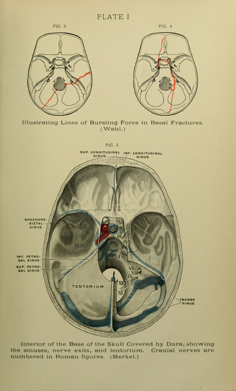 PLATE I FIG. 3 Illustrating Lines of Bursting Force in Basal Fractures. (Wahl.) FIG. 5 SUP. LONGITUDINAL , N F. LONGITUDINAL SINUS ! / SINUS SPHENOPA RIETAL SINUS INF. PETRO- SAL SINUS SUP. PETRO- SAL SINUS Interior of the Base of the Skull Covered by Dura, showing the sinuses, nerwe exits, and tentorium. Cranial nerves are numbered in Roman figures. (Merkel.)