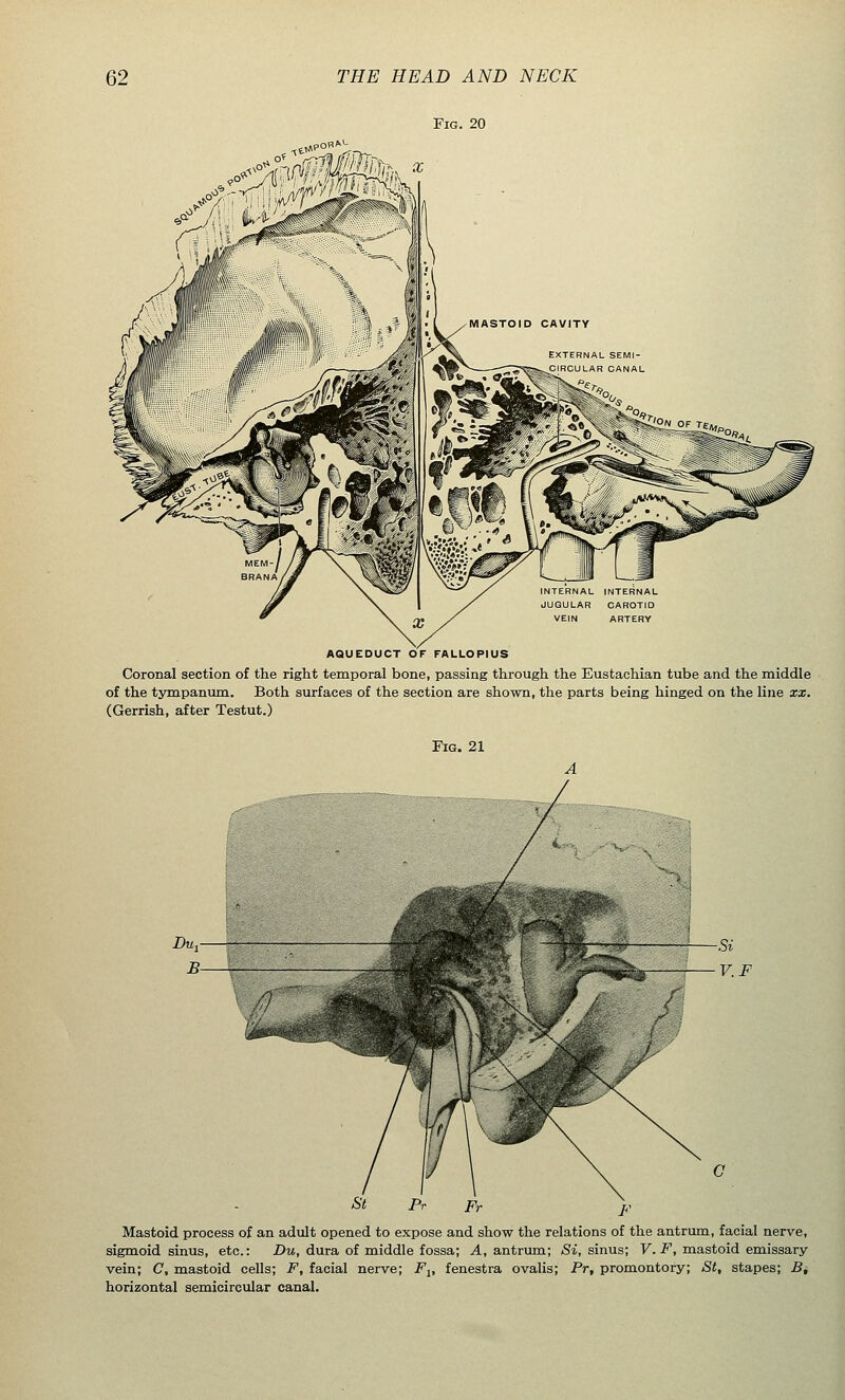 AQUEDUCT OF FALLOPIUS Coronal section of the right temporal bone, passing through the Eustachian tube and the middle of the tympanum. Both surfaces of the section are shown, the parts being hinged on the line xx. (Gerrish, after Testut.) Fig. 21 Mastoid process of an adult opened to expose and show the relations of the antrum, facial nerve, sigmoid sinus, etc.: Du, dura of middle fossa; A, antrum; Si, sinus; V.F, mastoid emissary vein; C, mastoid cells; F, facial nerve; Flt fenestra ovalis; Pr, promontory; St, stapes; B, horizontal semicircular canal.