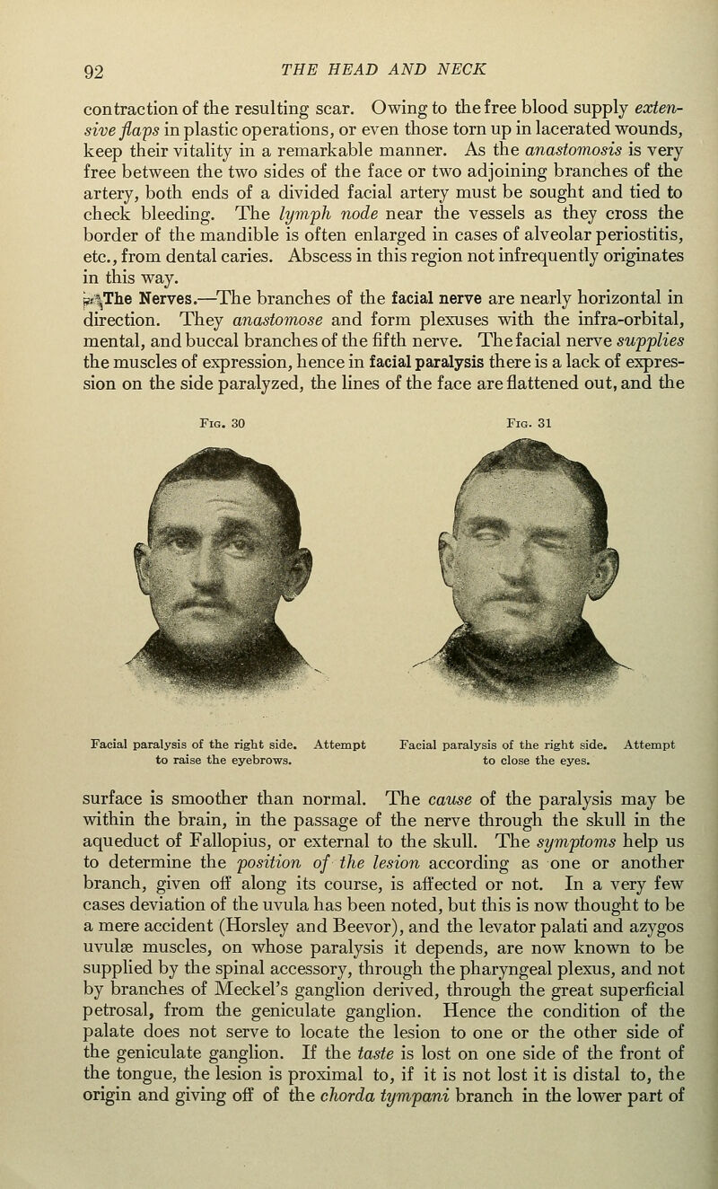 contraction of the resulting scar. Owing to the free blood supply exten- sive flaps in plastic operations, or even those torn up in lacerated wounds, keep their vitality in a remarkable manner. As the anastomosis is very free between the two sides of the face or two adjoining branches of the artery, both ends of a divided facial artery must be sought and tied to check bleeding. The lymph node near the vessels as they cross the border of the mandible is often enlarged in cases of alveolar periostitis, etc., from dental caries. Abscess in this region not infrequently originates in this way. p^The Nerves.—The branches of the facial nerve are nearly horizontal in direction. They anastomose and form plexuses with the infra-orbital, mental, and buccal branches of the fifth nerve. The facial nerve supplies the muscles of expression, hence in facial paralysis there is a lack of expres- sion on the side paralyzed, the lines of the face are flattened out, and the Fig. 30 Fig. 31 Facial paralysis of the right side. to raise the eyebrows. Attempt Facial paralysis of the right side, to close the eyes. Attempt surface is smoother than normal. The cause of the paralysis may be within the brain, in the passage of the nerve through the skull in the aqueduct of Fallopius, or external to the skull. The symptoms help us to determine the position of the lesion according as one or another branch, given off along its course, is affected or not. In a very few cases deviation of the uvula has been noted, but this is now thought to be a mere accident (Horsley and Beevor), and the levator palati and azygos uvulae muscles, on whose paralysis it depends, are now known to be supplied by the spinal accessory, through the pharyngeal plexus, and not by branches of Meckel's ganglion derived, through the great superficial petrosal, from the geniculate ganglion. Hence the condition of the palate does not serve to locate the lesion to one or the other side of the geniculate ganglion. If the taste is lost on one side of the front of the tongue, the lesion is proximal to, if it is not lost it is distal to, the origin and giving off of the chorda tympani branch in the lower part of