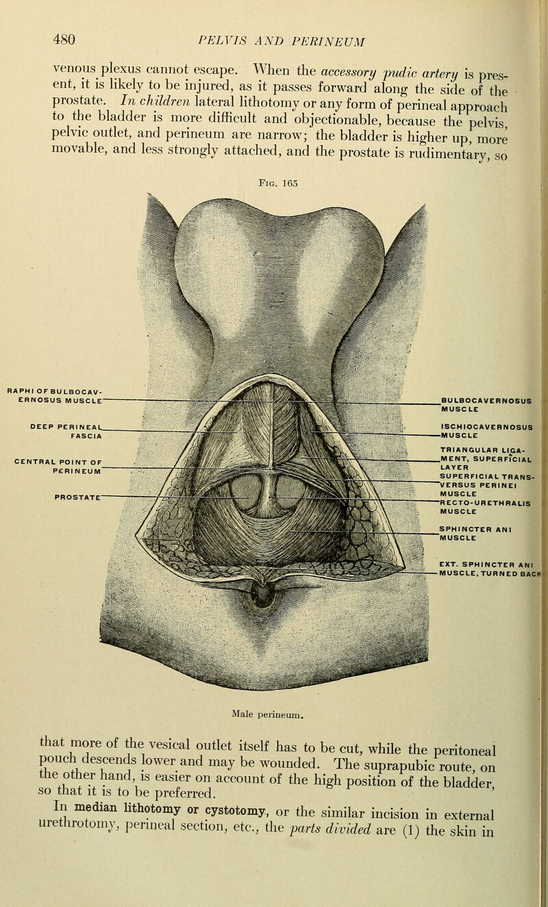 venous^ plexus cannot escape. When the accessory pudic artery is pres- ent, it is likely to be injured, as it passes forward along the side of the prostate. In children lateral lithotomy or any form of perineal approach to the bladder is more difficult and objectionable, because the pelvis pelvic outlet, and perineum are narrow; the bladder is higher up, more movable, and less strongly attached, and the prostate is rudimentary, so Fig. 165 RAPHI OFBULBOCAV- ERNOSUS MUSCLE DEEP PERINEAL. FASCIA CENTRAL POINT OF PERINEUM BULBOCAVERNOSUS MUSCLE ISCHIOCAVERNOSUS MUSCLE TRIANGULAR LIGA- MENT, SUPERFICIAL LAYER SUPERFICIALTRANS- VERSUS PERINEI MUSCLE RECTO-URETHRA LIS MUSCLE SPHINCTER ANI MUSCLE EXT. SPHINCTER ANI — MUSCLE,TURNED BACK Male perineum. that more of the vesical outlet itself has to be cut, while the peritoneal pouch descends lower and may be wounded. The suprapubic route, on the other hand, is easier on account of the high position of the bladder so that it is to be preferred. In median lithotomy or cystotomy, or the similar incision in external urethrotomy, perineal section, etc, the parts divided are (1) the skin in