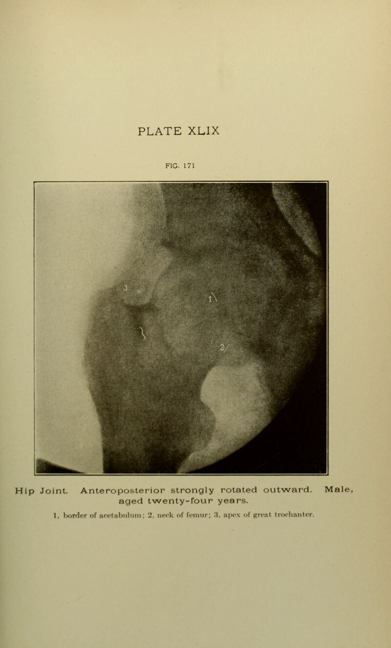 PLATE XLIX FIG. 171 Hip Joint. Anteroposterior strongly rotated outward. Male, aged twenty-four years. 1, border of acetabulum; 2, neck of femur; -i, apex of greal trochanter.