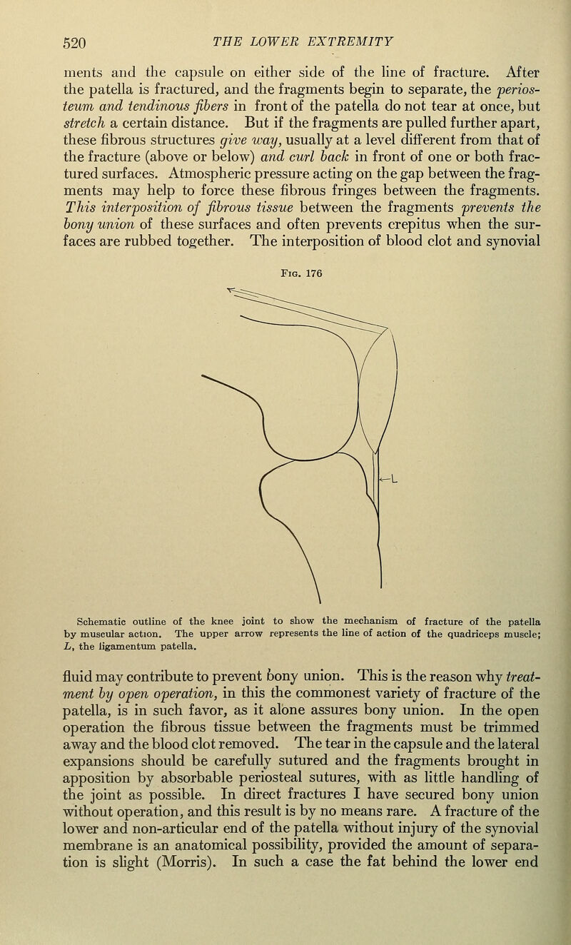 ments and the capsule on either side of the line of fracture. After the patella is fractured, and the fragments begin to separate, the perios- teum and tendinous fibers in front of the patella do not tear at once, but stretch a certain distance. But if the fragments are pulled further apart, these fibrous structures give way, usually at a level different from that of the fracture (above or below) and curl back in front of one or both frac- tured surfaces. Atmospheric pressure acting on the gap between the frag- ments may help to force these fibrous fringes between the fragments. This interposition of fibrous tissue between the fragments prevents the bony union of these surfaces and often prevents crepitus when the sur- faces are rubbed together. The interposition of blood clot and synovial Fig. 176 Schematic outline of the knee joint to show the mechanism of fracture of the patella by muscular action. The upper arrow represents the line of action of the quadriceps muscle; L, the ligamentum patella. fluid may contribute to prevent bony union. This is the reason why treat- ment by open operation, in this the commonest variety of fracture of the patella, is in such favor, as it alone assures bony union. In the open operation the fibrous tissue between the fragments must be trimmed away and the blood clot removed. The tear in the capsule and the lateral expansions should be carefully sutured and the fragments brought in apposition by absorbable periosteal sutures, with as little handling of the joint as possible. In direct fractures I have secured bony union without operation, and this result is by no means rare. A fracture of the lower and non-articular end of the patella without injury of the synovial membrane is an anatomical possibility, provided the amount of separa- tion is slight (Morris). In such a case the fat behind the lower end