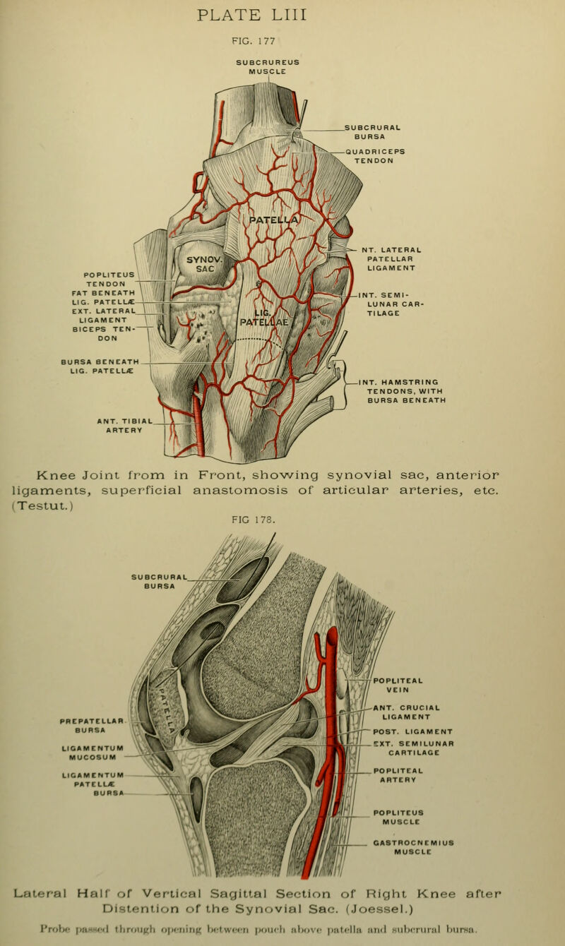 SUBCBUREUS MUSCLE POPLITEUS TENDON FAT BENEATH LIG. PATELUE EXT. LATERAL. LIGAMENT BICEPS TEN- : DON BURSA BENEATH LIG. PATELLA ANT. TIBIAL ARTERY SUBCRURAL BURSA QUADRICEPS TENDON NT. LATERAL PATELLAR LIGAMENT NT. SEMI- LUNAR CAR- TILAGE INT. HAMSTRING TENDONS, WITH BURSA BENEATH Knee Joint from in Front, showing synovial sae, anterior ligaments, superficial anastomosis of articular arteries, etc. (Testut.) FIG 173. SUBCRU BURS PREPATELLAR BURSA LIGAMENTUM MUCOSUM LIGAMENTUM PATE LL/E BURSA POPLITEAL VEIN ANT. CRUCIAL LIGAMENT POST. LIGAMENT I _ ^XT. SEMILUNAR CARTILAGE POPLITEAL ARTERY POPLITEUS MUSCLE GASTROCNEMIUS MUSCLE Lateral Half or Vertical Sagittal Section of Right Knee after Distention of the Synovial Sac. (Joessel.) Iv.li.- pawed through opening between pouch above patella and subcrural buna,