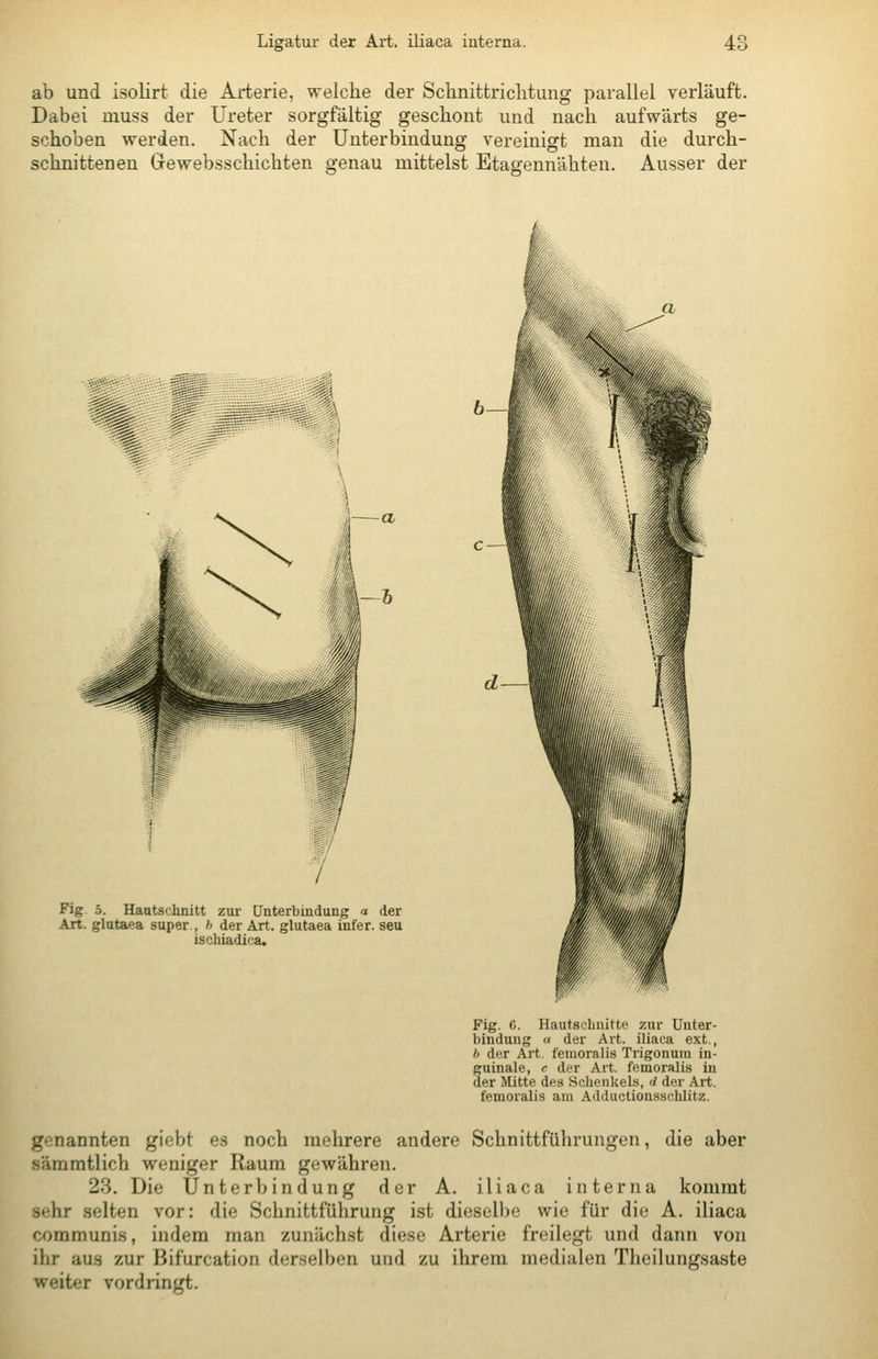 ab und isolirt die Arterie, welche der Schnittriclitimg parallel verläuft. Dabei muss der Ureter sorgfältig geschont und nach aufwärts ge- schoben werden. Nach der Unterbindung vereinigt man die durch- schnittenen Gewebsschichten genau mittelst Etasennähten. Ausser der Fig. 5. Hautschnitt zur [Jnterbmdung a der Art. glutaea super., h der Art. glutaea infer. seu ischiadica. Fig. 6. Hautschnitte zur Unter- bindung a der Art. iliaca ext., b der Art. femoralis Trigonum in- guinale, c der Art. femoralis in der Mitte des Schenkels, rf der Art. femoralis am Adductionsschlitz. genannten gicbt es noch mehrere andere Schnittführungen, die aber sämmtlich weniger Raum gewähren. 23. Die Unterbindung der A. iliaca interna kommt sehr selten vor: die Schnittführung ist dieselbe wie für die A. iliaca communis, indem man zunächst diese Arterie freilegt und dann von ihr aus zur Bifurcation derselben und zu ihrem medialen Theilungsaste weiter vordringt.