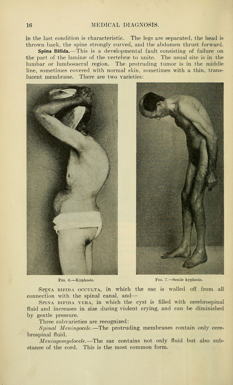 in the last condition is characteristic. The legs are separated, the head is thrown back, the spine strongly curved, and the abdomen thrust forward. Spina Bifida.—This is a developmental fault consisting of failure on the part of the laminae of the vertebrae to unite. The usual site is in the lumbar or lumbosacral region. The protruding tumor is in the middle line, sometimes covered with normal skin, sometimes with a thin, trans- lucent membrane. There are two varieties: Fig. 6.—Kyphosis. Fig. 7.—Senile kyphosis. Spina bifida occulta, in which the sac is walled off from all connection with the spinal canal, and— Spina bifida vera, in which the cyst is filled with cerebrospinal fluid and increases in size during violent crying, and can be diminished by gentle pressure. Three subvarieties are recognized: Spinal Meningocele.—The protruding membranes contain onl}^ cere- brospinal fluid. Meningomyelocele.—The sac contains not only fluid but also sub- stance of the cord. This is the most common form.