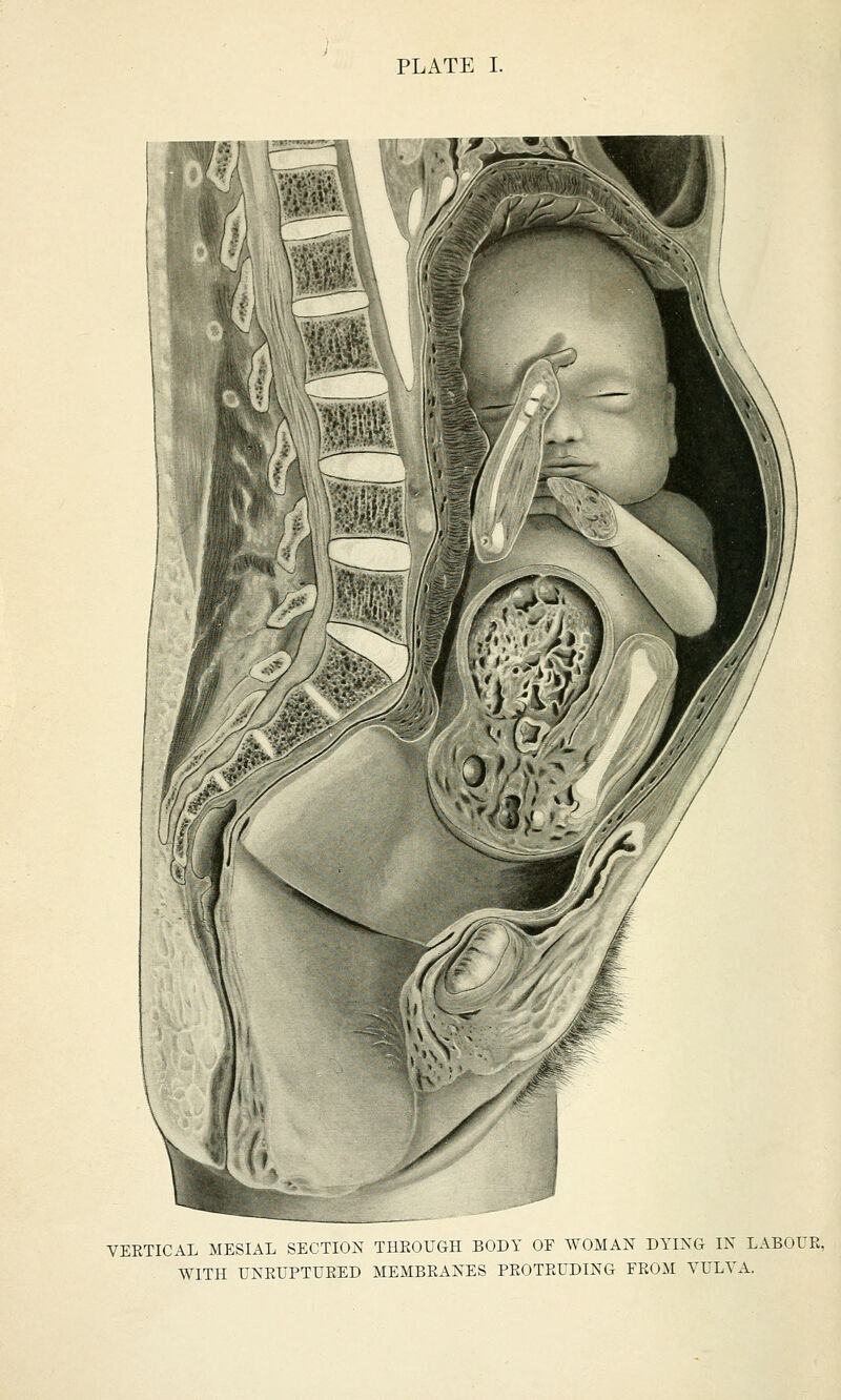 PLATE I. VEETICAL MESIAL SECTION THKOUGH BODY OF WOMAN DYING IN LABOUR, WITH UNRUPTURED MEMBRANES PROTRUDING FROM VULVA.