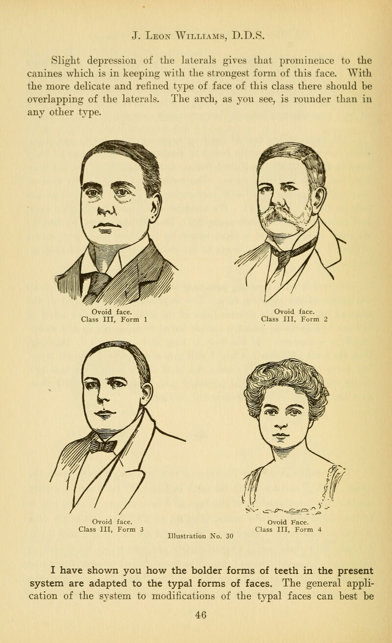 Slight depression of the laterals gives that proiniiieiice to the canines which is in keeping with the strongest form of this face. With the more delicate and refined type of face of this class there should be overlapping of the laterals. The arch, as you see, is rounder than in any other type. Ovoid face. Class III, Form 1 Ovoid face. Class III, Form 2 Ovoid face. Class III, Form 3 Illustration No. 30 Ovoid Face. Class III, Form 4 I have shown you how the bolder forms of teeth in the present system are adapted to the typal forms of faces. The general appli- cation of the system to modifications of the typal faces can best be