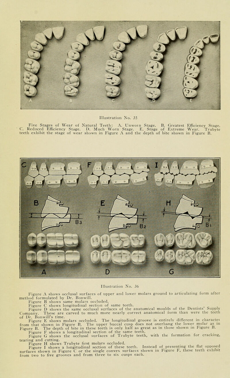 Five Stages of Wear of Natural Teeth: A. Unworn Stage. B. Greatest Efficiency Stage. C. Reduced Efficiency Stage. D. Much Worn Stage. E. Stage of Extreme Wear. Trubyte teeth exhibit the stage of wear shown in Figure A and the depth of bite shown in Figure B. Illustration No. 36 Figure A shows occlusal surfaces of upper and lower molars ground to articulating form after method formulated by Dr. Bonwill. Figure B shows same molars occluded. Figure C shows longitudinal section of same teeth. Figure D shows the same occlusal surfaces of the anatomical moulds of the Dentists Supply Company. These are carved to much more nearly correct anatomical form than were the teeth of Dr. Bonwill's time. Figure E shows molars occluded. The longitudinal groove is entirely different in charactei from that shown in Figure B. The upper buccal cusp does not overhang the lower molar as in Figure B. The depth of bite in these teeth is only half as great as in those shown in Figure B. Figure F shows a longitudinal section of the same teeth. Figure G shows the occlusal surfaces of Trubyte teeth, with the formation for cracking, tearing and cutting. Figure H shows Trubyte first molars occluded. ■ n j Figure I shows a longitudinal section of these teeth. Instead of presenting the flat opposed surfaces shown in Figure C or the single convex surfaces shown in Figure F, these teeth exhibit from two to five grooves and from three to six cusps each.