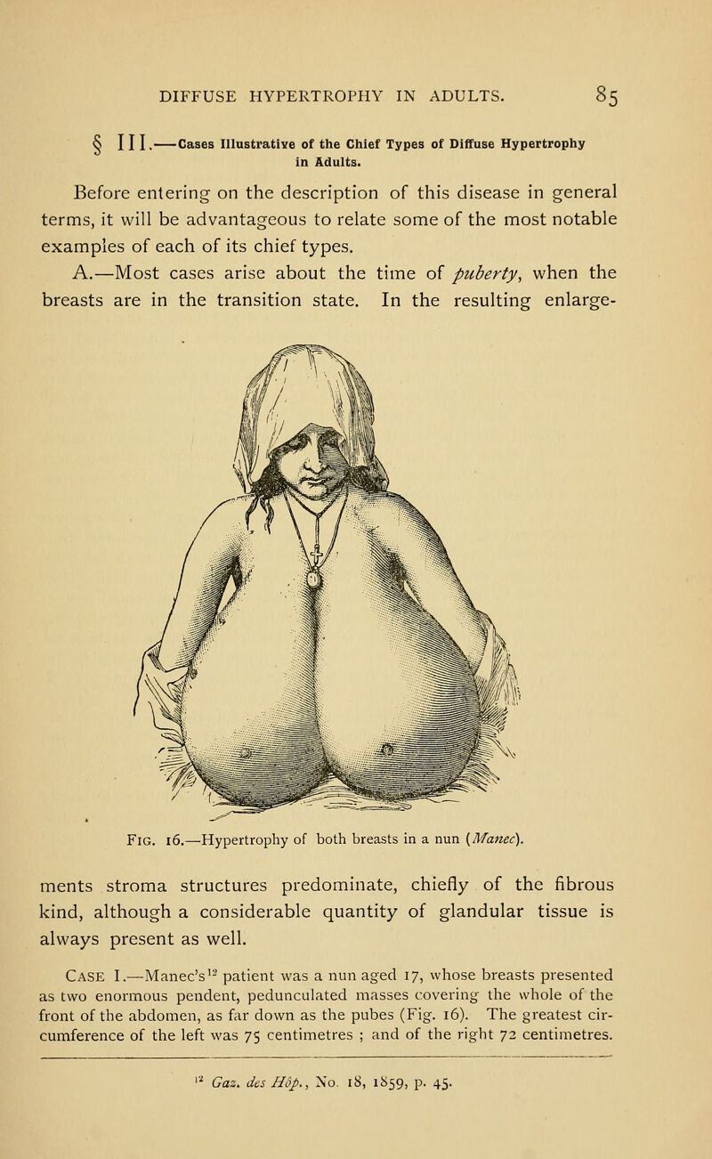 § in -Cases Illustrative of the Chief Types of Diffuse Hypertrophy in Adults. Before entering on the description of this disease in general terms, it will be advantageous to relate some of the most notable examples of each of its chief types. A.—Most cases arise about the time of puberty, when the breasts are in the transition state. In the resulting enlarge- FiG. 16.—-Hypertrophy of both breasts in a nun {Manec). ments stroma structures predominate, chiefly of the fibrous kind, although a considerable quantity of glandular tissue is always present as well. Case I.—Manec's'^ patient was a nun aged 17, whose breasts presented as two enormous pendent, pedunculated masses covering the whole of the front of the abdomen, as far down as the pubes (Fig. 16). The greatest cir- cumference of the left was 75 centimetres ; and of the right 72 centimetres. Gaz. des Hop., No. 18, 1859, p. 45.