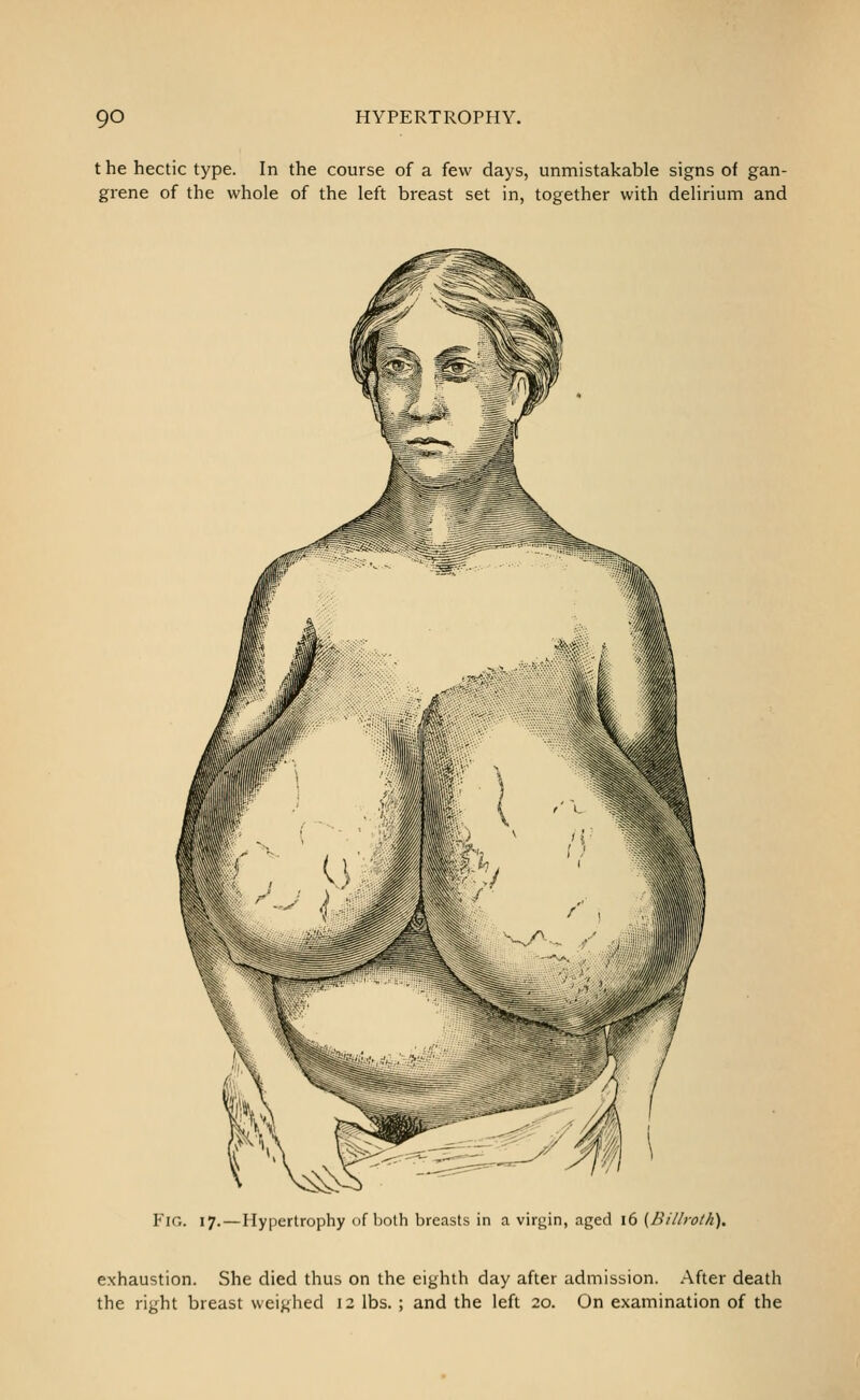 t he hectic type. In the course of a few days, unmistakable signs of gan- grene of the whole of the left breast set in, together with delirium and Fio. 17. — Hypertrophy of both breasts in a virgin, aged 16 {Billroth). exhaustion. She died thus on the eighth day after admission. After death the right breast weighed 12 lbs. ; and the left 20. On examination of the