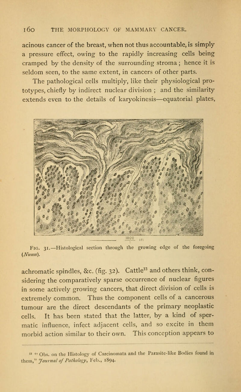 acinous cancer of the breast, when not thus accountable, is simply a pressure effect, owing to the rapidly increasing cells being cramped by the density of the surrounding stroma; hence it is seldom seen, to the same extent, in cancers of other parts. The pathological cells multiply, like their physiological pro- totypes, chiefly by indirect nuclear division ; and the similarity extends even to the details of karyokinesis—equatorial plates. mm Mc^A'^^^''^''^' A '0 f^ J tr » ^Ji Fig. 31.—Histological section through the growing edge of the foregoing achromatic spindles, &c. (fig. 32). Cattle^^ and others think, con- sidering the comparatively sparse occurrence of nuclear figures in some actively growing cancers, that direct division of cells is extremely common. Thus the component cells of a cancerous tumour are the direct descendants of the primary neoplastic cells. It has been stated that the latter, by a kind of sper- matic influence, infect adjacent cells, and so excite in them morbid action similar to their own. This conception appears to '■•  Ohs. on the Histology of Carcinoiiidta and the Parasite-like Bodies found in \.\iii\\\''' Journal of Pathologyy Feb., 1894.