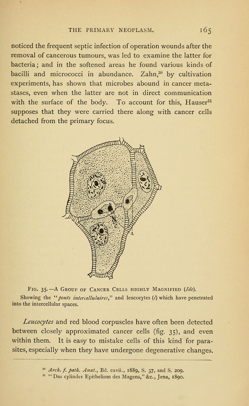 noticed the frequent septic infection of operation wounds after the removal of cancerous tumours, was led to examine the latter for bacteria; and in the softened areas he found various kinds of bacilli and micrococci in abundance. Zahn/° by cultivation experiments, has shown that microbes abound in cancer meta- stases, even when the latter are not in direct communication with the surface of the body. To account for this, Hauser^^ supposes that they were carried there along with cancer cells detached from the primary focus. Fig. 35.—a Group of Cancer Cells highly Magnified {Ide). Showing the ponts intercellulaires and leucocytes (/) which have penetrated into the intercellular spaces. Leucocytes and red blood corpuscles have often been detected between closely approximated cancer cells (iig. 35), and even within them. It is easy to mistake cells of this kind for para- sites, especially when they have undergone degenerative changes. ^'' Arch. f. path. Anat., Bd. cxvii., 1889, S. 37, and S. 209.