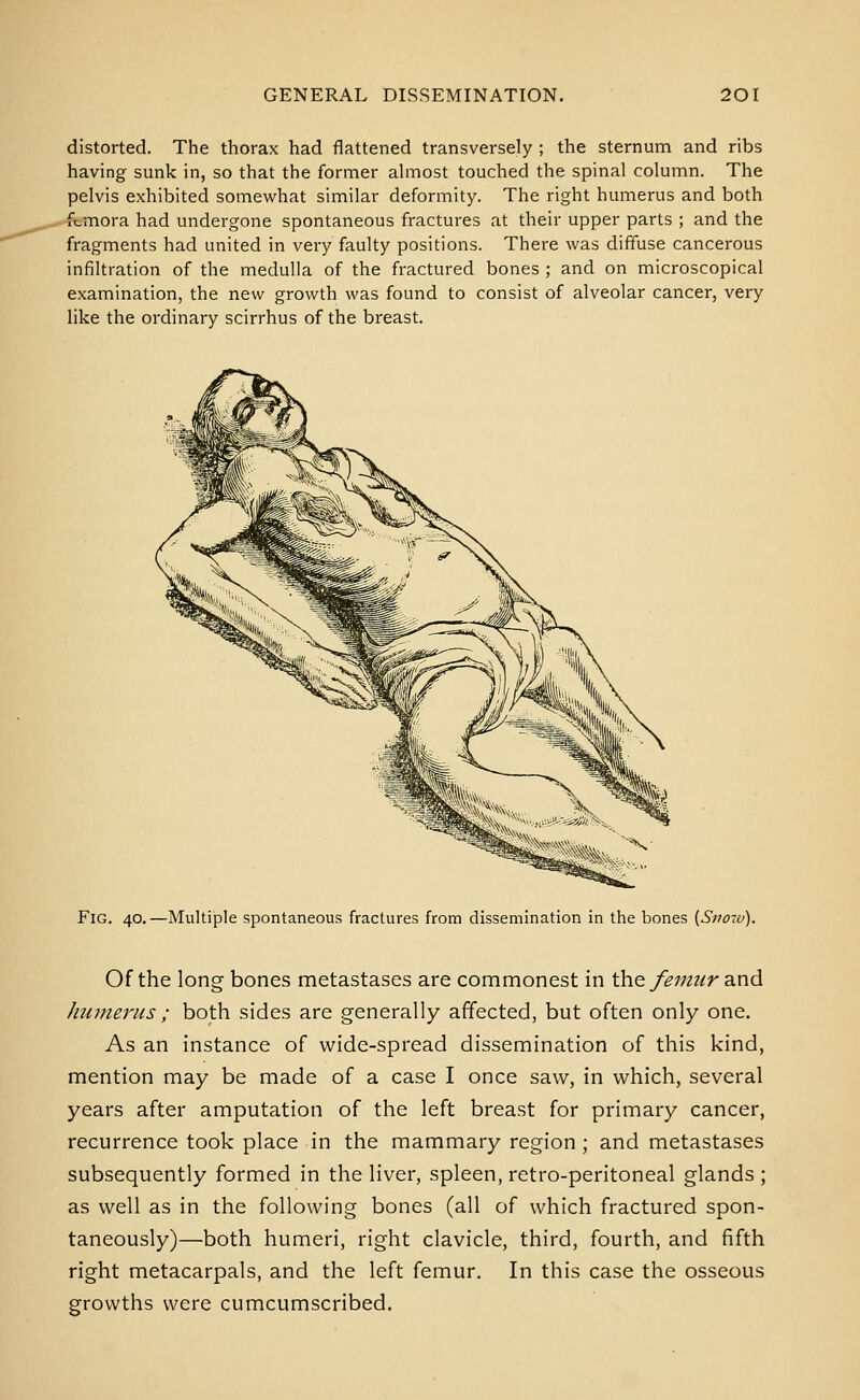 distorted. The thorax had flattened transversely ; the sternum and ribs having sunk in, so that the former ahnost touched the spinal column. The pelvis exhibited somewhat similar deformity. The right humerus and both femora had undergone spontaneous fractures at their upper parts ; and the fragments had united in very faulty positions. There was diffuse cancerous infiltration of the medulla of the fractured bones ; and on microscopical examination, the new growth was found to consist of alveolar cancer, very like the ordinary scirrhus of the breast. Fig. 40.—Multiple spontaneous fractures from dissemination in the bones {Sno-v). Of the long bones metastases are commonest in the femur ^.xxd humerus ; both sides are generally affected, but often only one. As an instance of wide-spread dissemination of this kind, mention may be made of a case I once saw, in which, several years after amputation of the left breast for primary cancer, recurrence took place in the mammary region ; and metastases subsequently formed in the liver, spleen, retro-peritoneal glands ; as well as in the following bones (all of which fractured spon- taneously)—both humeri, right clavicle, third, fourth, and fifth right metacarpals, and the left femur. In this case the osseous growths were cumcumscribed.