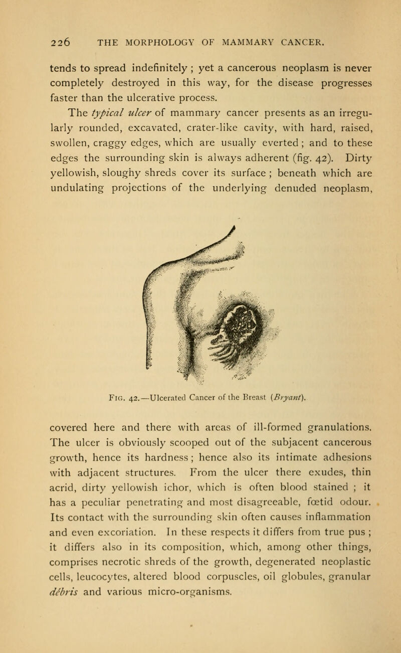 tends to spread indefinitely ; yet a cancerous neoplasm is never completely destroyed in this way, for the disease progresses faster than the ulcerative process. The typical ulcer of mammary cancer presents as an irregu- larly rounded, excavated, crater-like cavity, with hard, raised, swollen, craggy edges, which are usually everted ; and to these edges the surrounding skin is always adherent (fig. 42). Dirty yellowish, sloughy shreds cover its surface ; beneath which are undulating projections of the underlying denuded neoplasm, Fk;. 42.—Ulcerated Cancer of the Breast (Bryant). covered here and there with areas of ill-formed granulations. The ulcer is obviously scooped out of the subjacent cancerous growth, hence its hardness ; hence also its intimate adhesions with adjacent structures. From the ulcer there exudes, thin acrid, dirty yellowish ichor, which is often blood stained ; it has a peculiar penetrating and most disagreeable, foetid odour. Its contact with the surrounding skin often causes inflammation and even excoriation. In these respects it differs from true pus ; it differs also in its composition, which, among other things, comprises necrotic shreds of the growth, degenerated neoplastic cells, leucocytes, altered blood corpuscles, oil globules, granular dtfbris and various micro-organism.s.