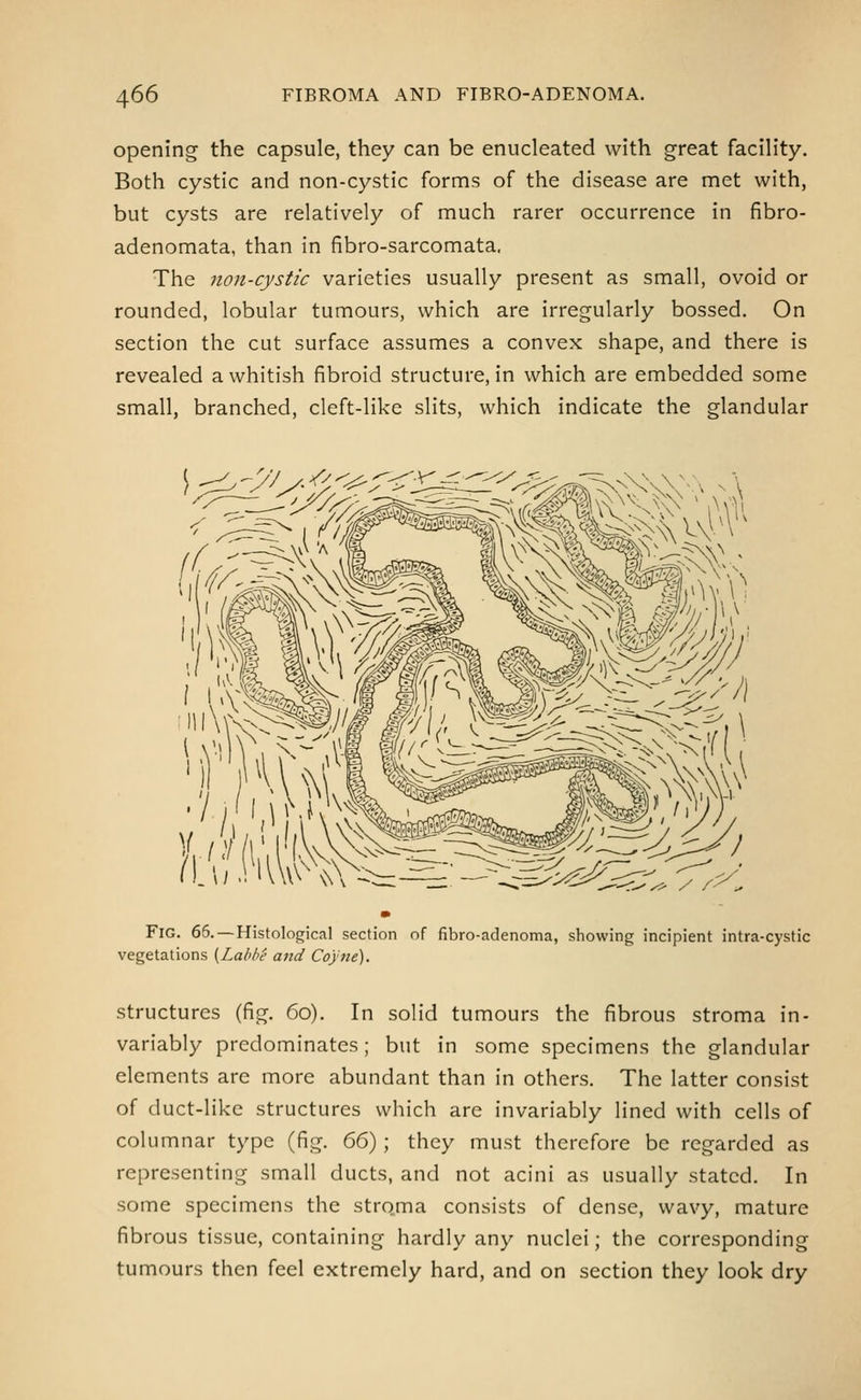 opening the capsule, they can be enucleated with great facility. Both cystic and non-cystic forms of the disease are met with, but cysts are relatively of much rarer occurrence in fibro- adenomata, than in fibro-sarcomata. The non-cystic varieties usually present as small, ovoid or rounded, lobular tumours, which are irregularly bossed. On section the cut surface assumes a convex shape, and there is revealed a whitish fibroid structure, in which are embedded some small, branched, cleft-like slits, which indicate the glandular Fig. 66.—Histological section of fibro-adenoma, showing incipient intra-cystic vegetations {Lahbe and Coyne). structures (fig. 60). In solid tumours the fibrous stroma in- variably predominates; but in some specimens the glandular elements are more abundant than in others. The latter consist of duct-like structures which are invariably lined with cells of columnar type (fig. 66); they must therefore be regarded as representing small ducts, and not acini as usually stated. In some specimens the stro.ma consists of dense, wavy, mature fibrous tissue, containing hardly any nuclei; the corresponding tumours then feel extremely hard, and on section they look dry