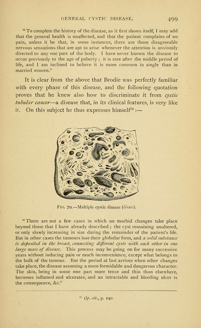  To complete the history of the disease, as it first shows itself, I may add that the general health is unaffected, and that the patient complains of no pain, unless it be that, in some instances, there are those disagreeable nervous sensations that are apt to arise whenever the attention is anxiously directed to any one part of the body. I have never known the disease to occur previously to the age of puberty ; it is rare after the middle period of life, and I am inclined to believe it is more common in single than in married women. It is clear from the above that Brodie was perfectly familiar with every phase of this disease, and the following quotation proves that he knew also how to discriminate it from cystic tubiilar cancer—a disease that, in its clinical features, is very like it. On this subject he thus expresses himselP^:— Fig. 70.—Multiple cystic disease {Gross).  There are not a few cases in which no morbid changes take place beyond those that I have already described ; the cyst remaining unaltered, or only slowly increasing in size during the remainder of the patient's life. But in other cases the tumours lose their globular form, and a solid substa7ice is deposited ifi the breast, connecting different cysts with each other i?i one large mass of disease. This process may be going on for many successive years without inducing pain or much inconvenience, except what belongs to the bulk of the tumour. But the period at last arrives when other changes take place, the disease assuming a more formidable and dangerous character. The skin, being in some one part more tense and thin than elsewhere, becomes inflamed and ulcerates, and an intractable and bleeding ulcer is the consequence, &c. ' Op. cit., p. 140.