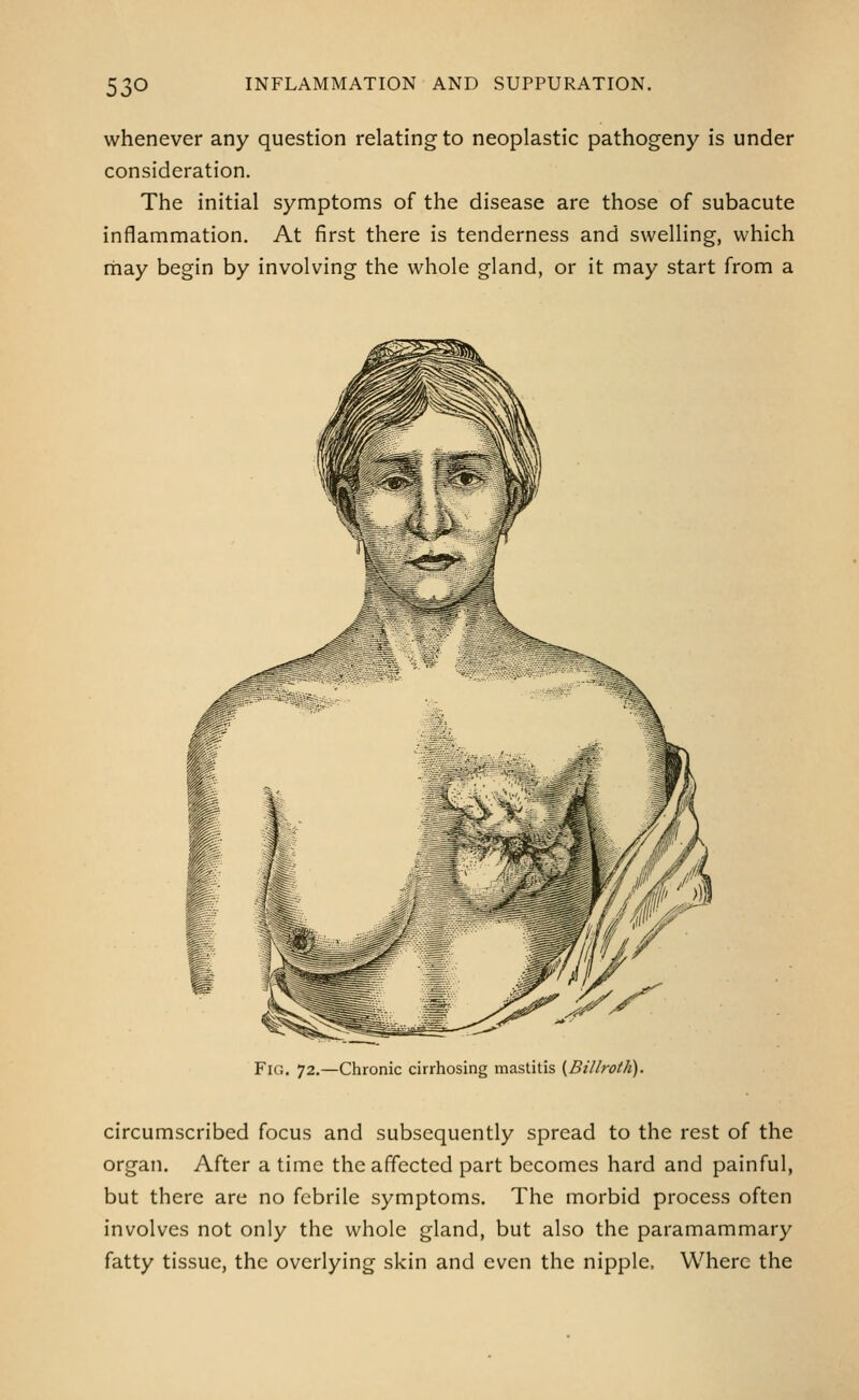 whenever any question relating to neoplastic pathogeny is under consideration. The initial symptoms of the disease are those of subacute inflammation. At first there is tenderness and swelling, which may begin by involving the whole gland, or it may start from a Fig. 72.—Chronic cirrhosing mastitis {Billroth). circumscribed focus and subsequently spread to the rest of the organ. After a time the affected part becomes hard and painful, but there are no febrile symptoms. The morbid process often involves not only the whole gland, but also the paramammary fatty tissue, the overlying skin and even the nipple. Where the