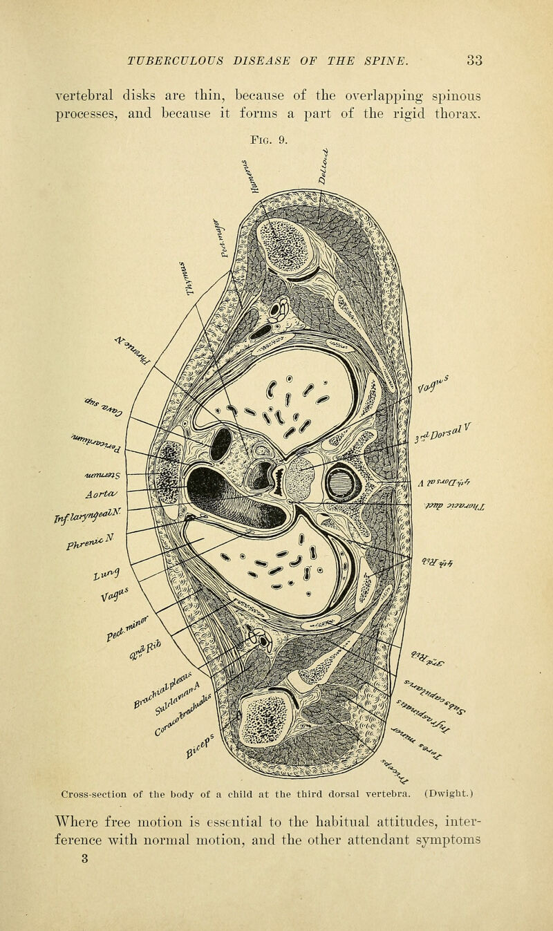 vertebral disks are thin, because of the overlapping spinous processes, and because it forms a part of the rigid thorax. Fig. 9. Cross-section of the body of a child at the third dorsal vertebra. (Dwight.) Where free motion is essential to the habitual attitudes, inter- ference with normal motion, and the other attendant symptoms 3