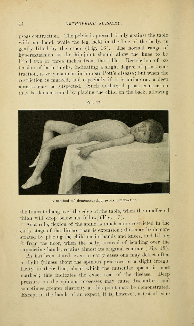 psoas contraction. The pelvis is pressed firmly against the table with one hand, while the leg, held in the line of the body, is gently lifted by the other (Fig. 16). The normal range of hyperextension at the hip-joint should allow the knee to be lifted two or three inches from the table. Restriction of ex- tension of both thighs, indicating a slight degree of psoas con- traction, is very common in lumbar Pott's disease; but when the restriction is marked, and especially if it is unilateral, a deep abscess may be suspected. Such unilateral psoas contraction may be demonstrated by placing the child on the back, allowing Fig. 17. A method of demonstrating psoas contraction. the limbs to hang over the edge of the table, when the unaffected thigh will drop below its fellow (Fig. 17). As a rule, flexion of the spine is much more restricted in the early stage of the disease than is extension; this may be demon- strated by placing the child on its hands and knees, and lifting it from the floor, when the body, instead of bending over the supporting hands, retains almost its original contour (Fig. 18). As has been stated, even in early cases one may detect often a slight fulness about the spinous processes or a slight irregu- larity in their line, about which the muscular spasm is most marked; this indicates the exact seat of the disease. Deep pressure on the spinous processes may cause discomfort, and sometimes greater elasticity at this point may be demonstrated. Except in the hands of an expert, it is, however, a test of com-