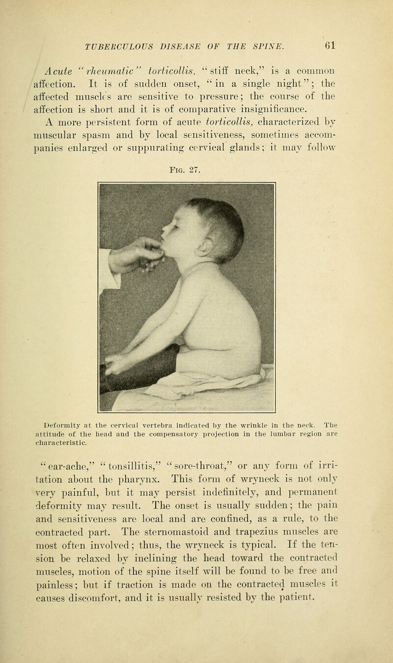 Acute rheumatic torticollis, stiff neck, is a common affection. It is of sudden onset, in a single night; the affected muscles are sensitive to pressure; the course of the affection is short and it is of comparative insigTiificance. A more persistent form of acute torticollis, characterized by muscular spasm and by local sensitiveness, sometimes accom- panies enlarged or suppurating cervical glands; it may follow Fig. 27. Deformity at the cervical vertebra indicated by the vrrinkle in the neck. The attitude of the head and the compensatory projection in the lumbar region are characteristic. ear-ache, tonsillitis, sore-throat, or any form of irri- tation about the pharynx. This form of wryneck is not only very painful, but it may persist indefinitely, and permanent deformity may result. The onset is usually sudden; the pain and sensitiveness are local and are confined, as a rule, to the contracted part. The sternomastoid and trapezius muscles are most often involved; thus, the wryneck is typical. If the ten- sion be relaxed by inclining the head toward the contracted muscles, motion of the spine itself will be found to be free and painless; but if traction is made on the contracted muscles it causes discomfort, and it is usually resisted by the patient.