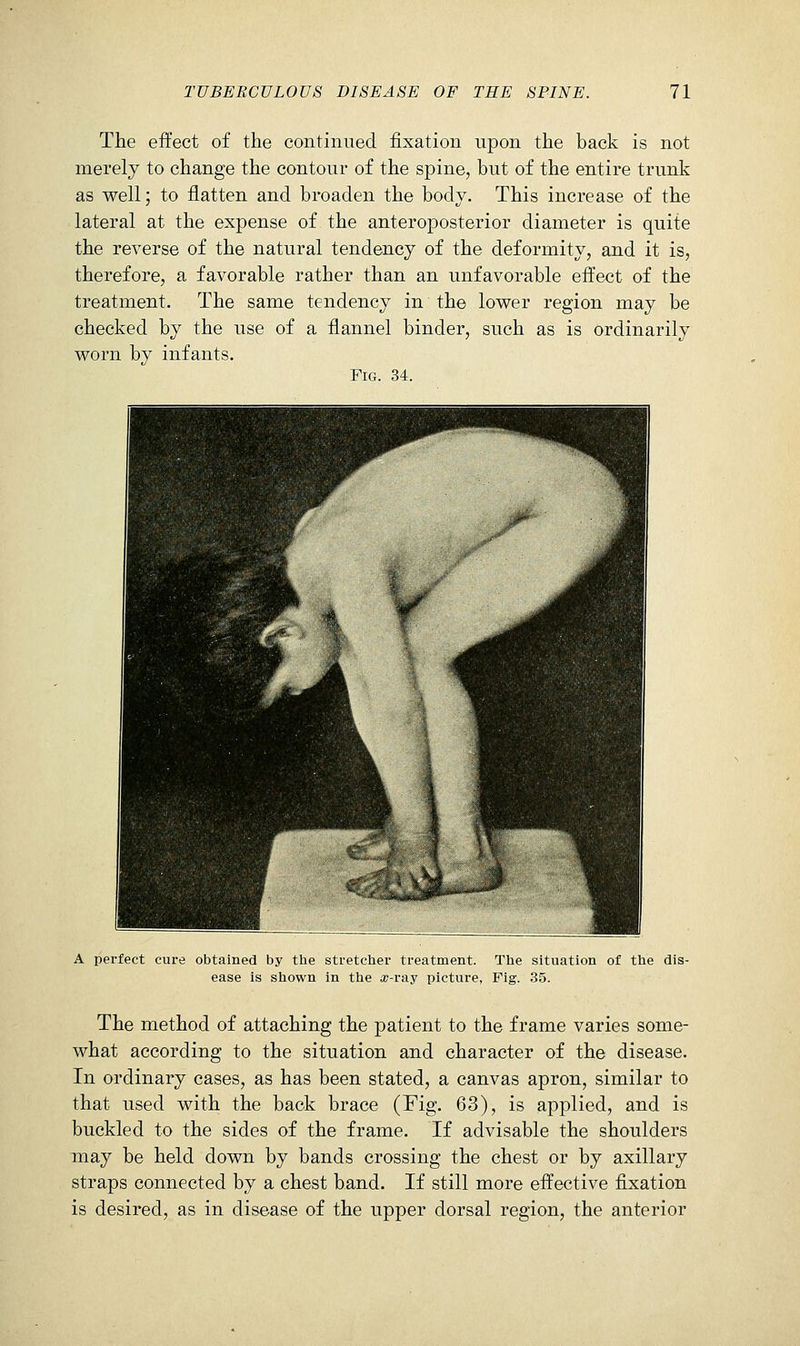 The effect of the continued fixation upon the back is not merely to change the contour of the spine, but of the entire trunk as well; to flatten and broaden the body. This increase of the lateral at the expense of the anteroposterior diameter is quite the reverse of the natural tendency of the deformity, and it is, therefore, a favorable rather than an unfavorable effect of the treatment. The same tendency in the lower region may be checked by the use of a flannel binder, such as is ordinarily worn by infants. Fig. 34. A perfect cure obtained by the stretcher treatment. The situation of the dis- ease is shown in the ir-ray picture, Fig. 35. The method of attaching the patient to the frame varies some- what according to the situation and character of the disease. In ordinary cases, as has been stated, a canvas apron, similar to that used with the back brace (Fig. 63), is applied, and is buckled to the sides of the frame. If advisable the shoulders may be held down by bands crossing the chest or by axillary straps connected by a chest band. If still more effective fixation is desired, as in disease of the upper dorsal region, the anterior