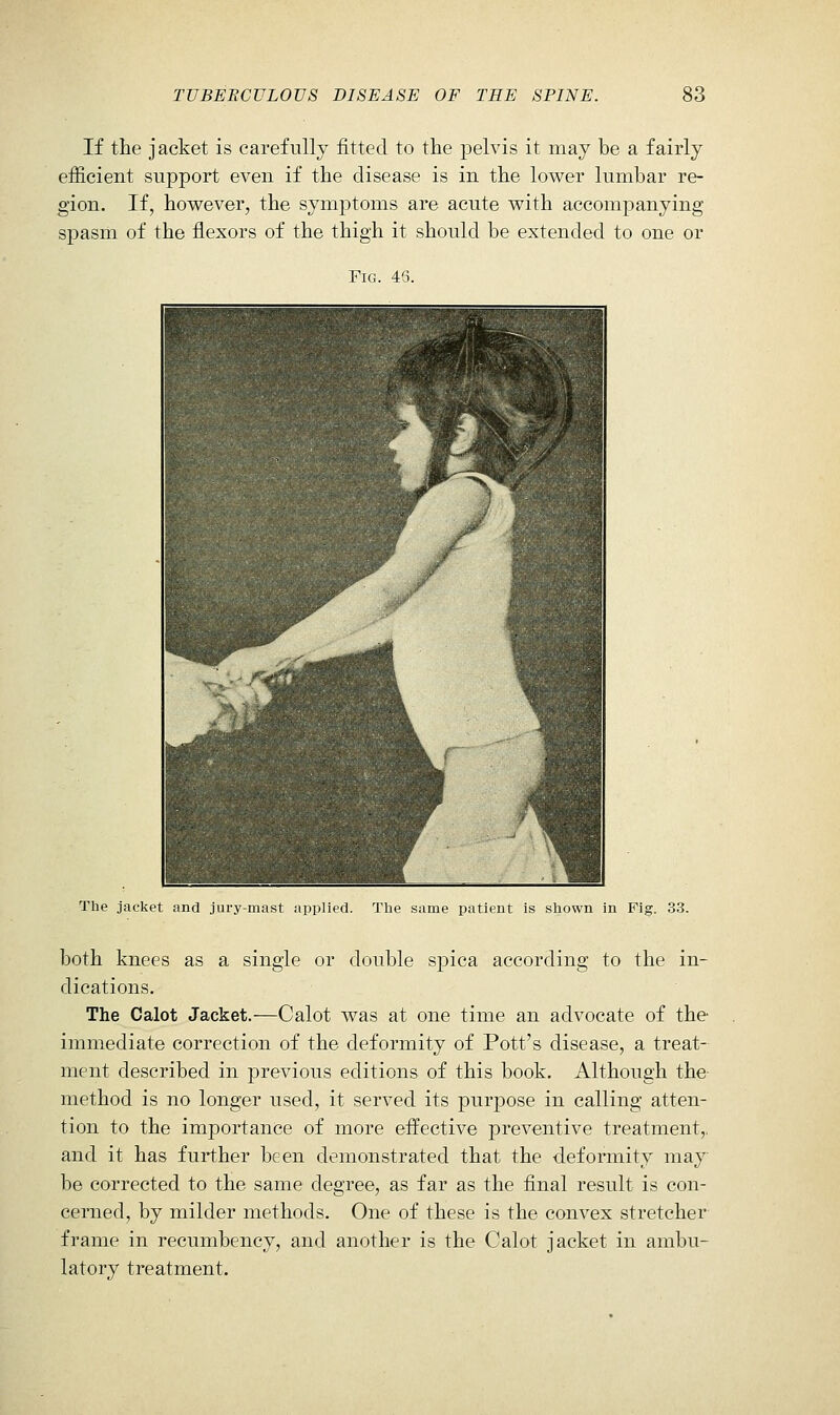 If the jacket is carefully fitted to the pelvis it may be a fairly efficient support even if the disease is in the lower lumbar re- gion. If, however, the symptoms are acute with accompanying spasm of the flexors of the thigh it should be extended to one or Fig. 45. The jacket and jury-mast applied. The same patient is shown in Fig. 33. both knees as a single or double spica according to the in- dications. The Calot Jacket.—Calot was at one time an advocate of the immediate correction of the deformity of Pott's disease, a treat- ment described in previous editions of this book. Although the- method is no longer used, it served its purpose in calling atten- tion to the importance of more effective preventive treatment,, and it has further been demonstrated that the deformity may be corrected to the same degree, as far as the final result is con- cerned, by milder methods. One of these is the convex stretcher frame in recumbency, and another is the Calot jacket in ambu- latory treatment.