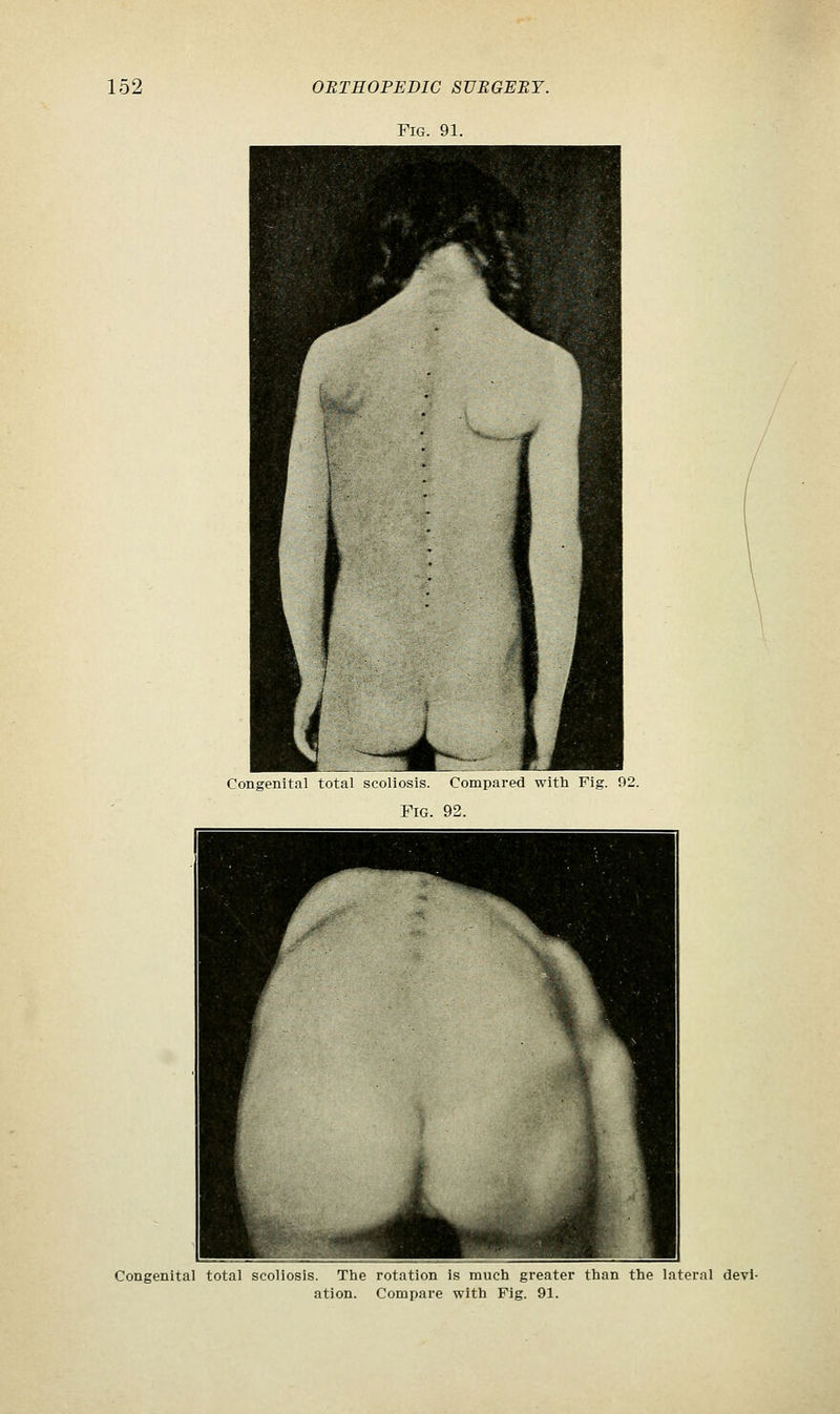 Fig. 91. CongeBital total scoliosis. Compared with Fig. 92. Fig. 92. Congenital total scoliosis. The rotation is much greater than the lateral devi- ation. Compare with Fig. 91.