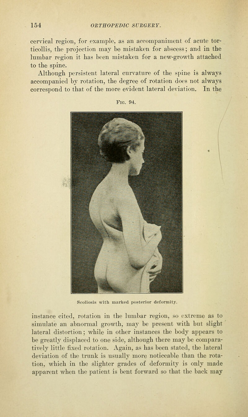 cervical region, for example, as an accompaniment of acute tor- ticollis, the projection may be mistaken for abscess; and in the lumbar region it has been mistaken for a new-growth attached to the spine. Although persistent lateral curvature of the spine is always accompanied by rotation, the degree of rotation does not always correspond to that of the more evident lateral deviation. In the Fig. 94. Scoliosis with marked posterior deformity. instance cited, rotation in the lumbar region, so extreme as to simulate an abnormal growth, maj be present with but slight lateral distortion; while in other instances the body appears to be greatly displaced to one side, although there may be compara- tively little fixed rotation. Again, as has been stated, the lateral deviation of the trunk is usually more noticeable than the rota- tion, which in the slighter grades of deformity is only made apparent when the patient is bent forward so that the back may