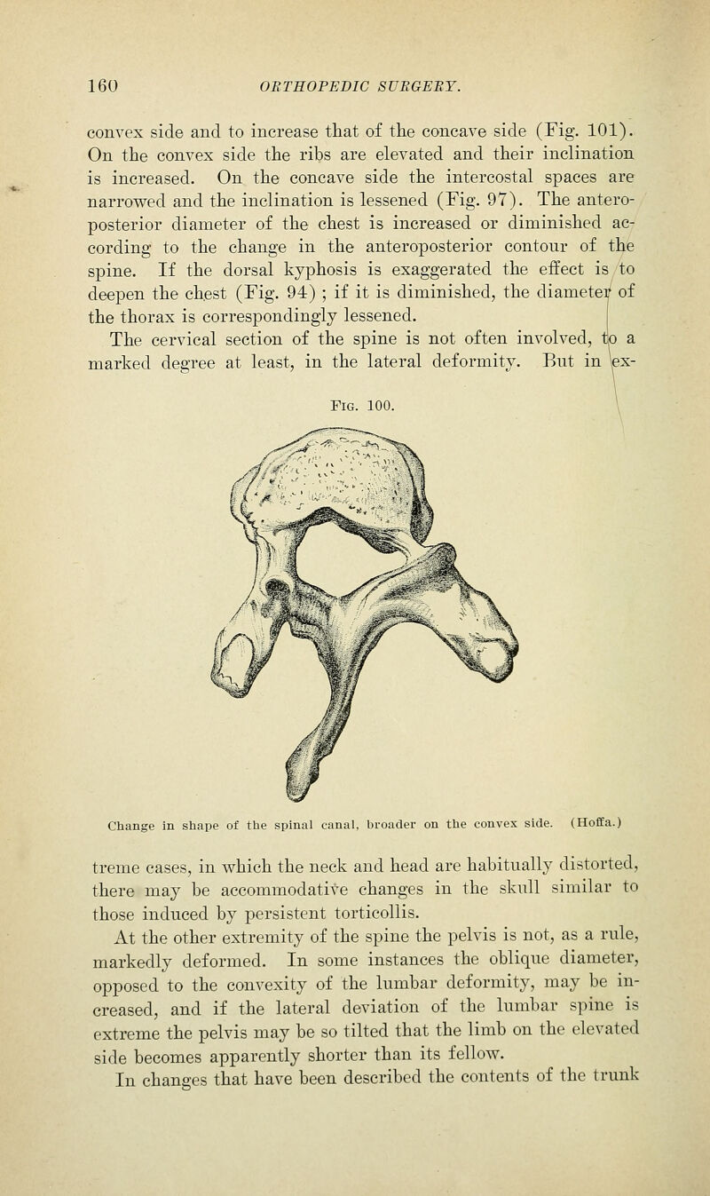 convex side and to increase that of the concave side (Fig. 101). On the convex side the ribs are elevated and their inclination is increased. On the concave side the intercostal spaces are narrowed and the inclination is lessened (Fig. 97). The antero- posterior diameter of the chest is increased or diminished ac- cording to the change in the anteroposterior contour of the spine. If the dorsal kyphosis is exaggerated the effect is to deepen the chest (Fig. 94) ; if it is diminished, the diametey of the thorax is correspondingly lessened. The cervical section of the spine is not often involved, marked degree at least, in the lateral deformity. But in \ex- FiG. 100. Change in shape of the spinal canal, broader on the convex side. (HofEa.) treme cases, in which the neck and head are habitually distorted, there may be accommodative changes in the skull similar to those induced by persistent torticollis. At the other extremity of the spiue the pelvis is not, as a rule, markedly deformed. In some instances the oblique diameter, opposed to the convexity of the lumbar deformity, may be in- creased, and if the lateral deviation of the lumbar spine is extreme the pelvis may be so tilted that the limb on the elevated side becomes apparently shorter than its fellow. In changes that have been described the contents of the trunk