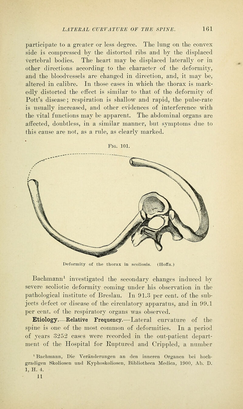 participate to a greater or less degree. The lung on the convex side is compressed by the distorted ribs and by the displaced vertebral bodies. The heart may be displaced laterally or in other directions according to the character of the deformity, and the bloodvessels are changed in direction, and, it may be, altered in calibre. In those cases in which the thorax is mark- edly distorted the effect is similar to that of the deformity of Pott's disease; respiration is shallow and rapid, the pulse-rate is usually increased, and other evidences of interference with the vital functions may be apparent. The abdominal organs are affected, doubtless, in a similar manner, but symptoms due to this cause are not, as a rule, as clearly marked. Fig. 101. Deformity of the thorax in scoliosis. (Hoffa.) Bachmann^ investigated the secondary changes induced by severe scoliotic deformity coming under his observation in the pathological institute of Breslau. In 91.3 per cent, of the sub- jects defect or disease of the circulatory apparatus, and in 99.1 per cent, of the respiratory organs was observed. Etiology—Relative Frequency.—Lateral curvature of the spine is one of the most common of deformities. In a period of years 3252 cases were recorded in the out-patient dej)art- ment of the Hospital for Euptured and Crippled, a number ^ Bachmann, Die Veranderungen an den inneren Organen bei hoch- gradigen Skoliosen und Kyphoskoliosen, Bibliotheca Medica, 1900, Ab. D. 1, H. 4. 11