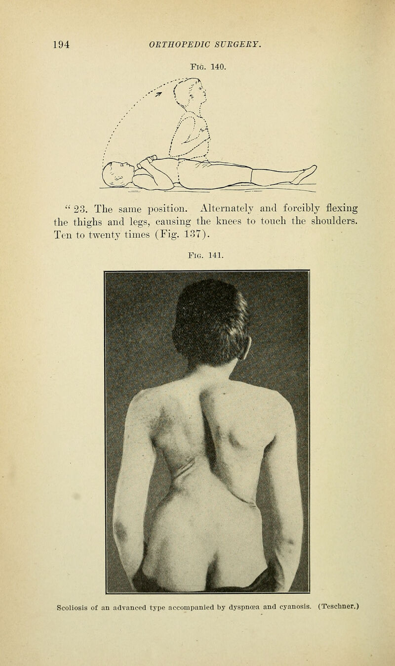 Fig. 140. X X...  23. The same position. Alternately and forcibly flexing the thighs and legs, causing the knees to touch the shoulders. Ten to twenty times (Fig. 137). Fig. 141. Scoliosis of an advanced type accompanied by dyspnoea and cyanosis. (Teschner.)