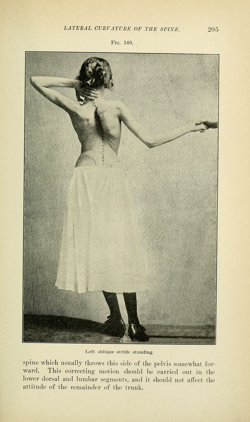 Fig. 149. Left oblique stride standing. spine which usually throws this side of the pelvis somewhat for- ward. This correcting motion should be carried out in the lower dorsal and lumbar segments, and it should not affect the attitude of the remainder of the trunk.