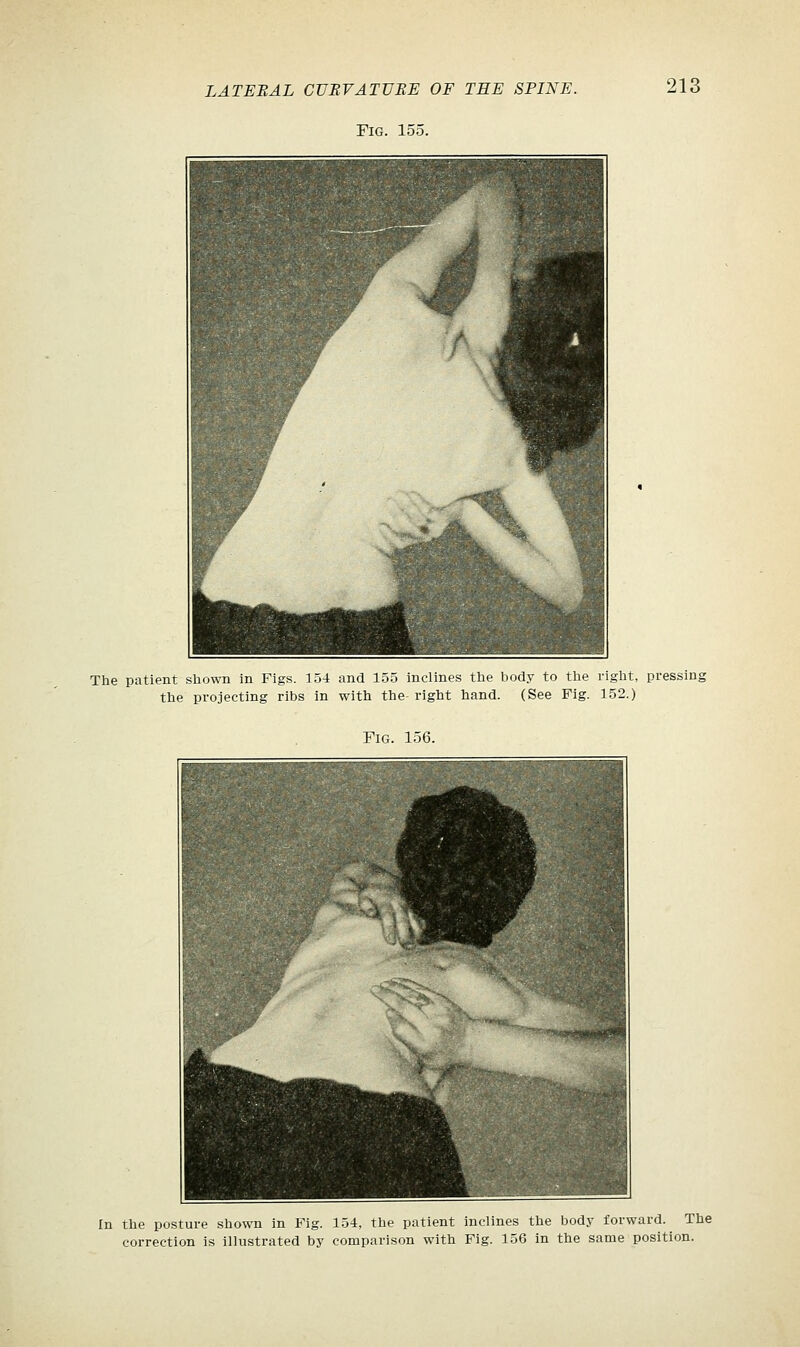 Fig. 155. 213 The patient shown in Figs. 154 and 155 inclines the body to the right, pressing the projecting ribs in with the right hand. (See Fig. 152.) Fig. 156. In the posture shown in Fig. 154, the patient inclines the body forward. The correction is illustrated by comparison with Fig. 156 in the same position.