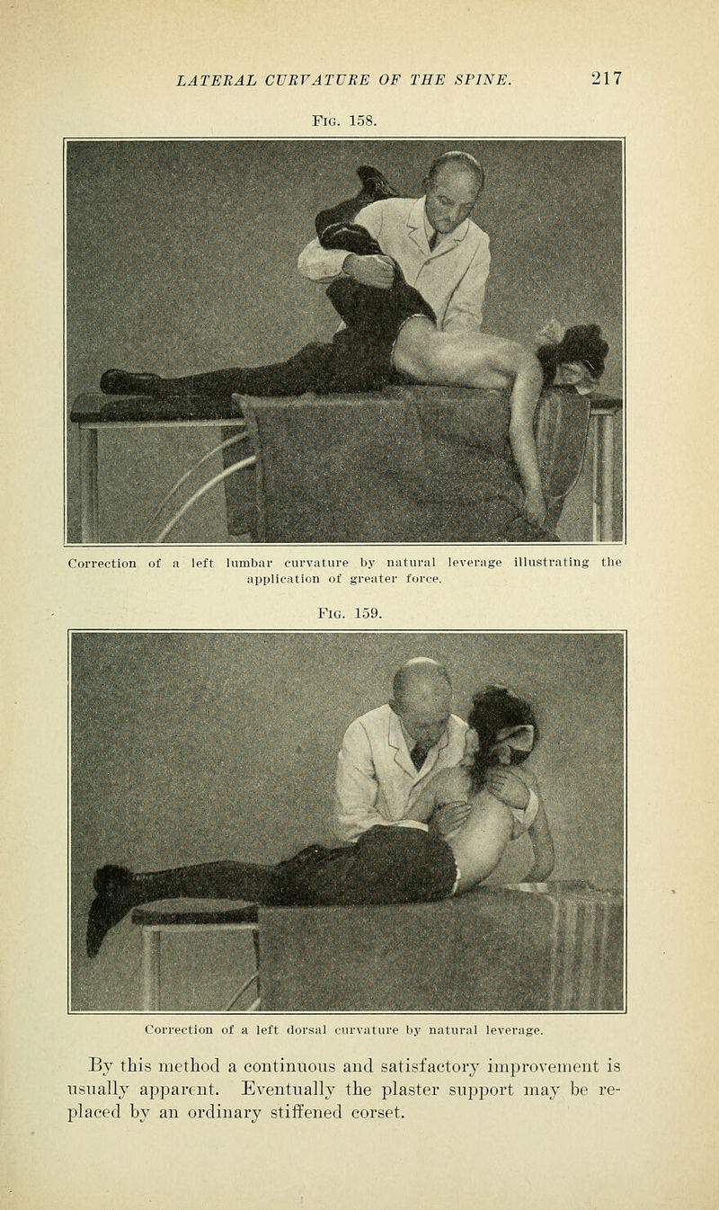 Fig. 158. Correction of n. left lumbar curvature by natural leverage illustrating the application of greater force. Fig. 159. < Oi iiri i(jn of a left dorsal curvature by natural leverage. By this method a continuous and satisfactory improvement is usually apparent. Eventually the plaster support may be re- placed by an ordinary stiffened corset.