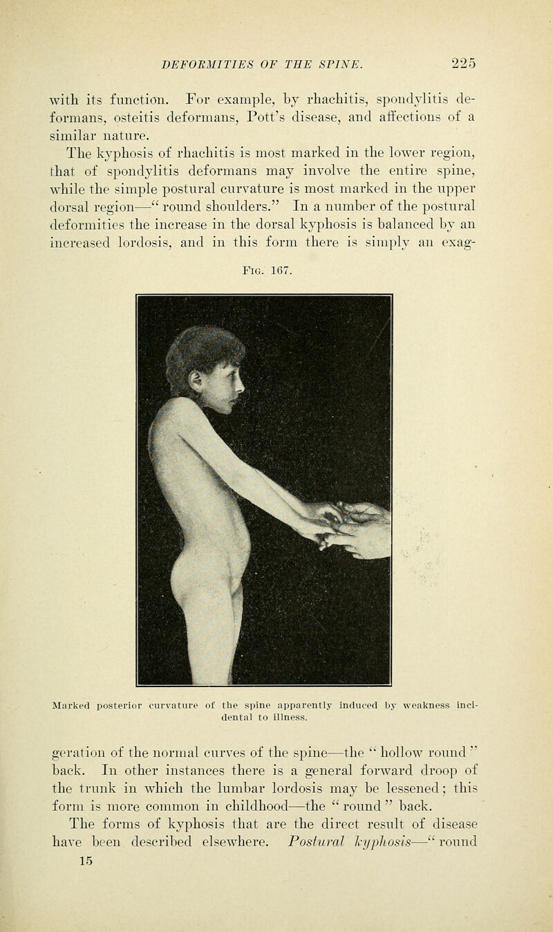 with its function. For example, by rhachitis, spondylitis de- formans, osteitis deformans, Pott's disease, and affections of a similar nature. The kyphosis of rhachitis is most marked in the lower region, that of spondylitis deformans may involve the entire spine, while the simple postural curvature is most marked in the upper dorsal region— round shoulders. In a number of the postural deformities the increase in the dorsal kyphosis is balanced by an increased lordosis, and in this form there is simply an exag- FiG. 167. Marked posterior curvature of the spine apparently induced by weakness Inci- dental to illness. geration of the normal curves of the spine—the  hollow round  back. In other instances there is a general forward droop of the trunk in which the lumbar lordosis may be lessened; this form is more common in childhood—the  round  back. The forms of kyphosis that are the direct result of disease have been described elsewhere. Postural kyphosis— round 15