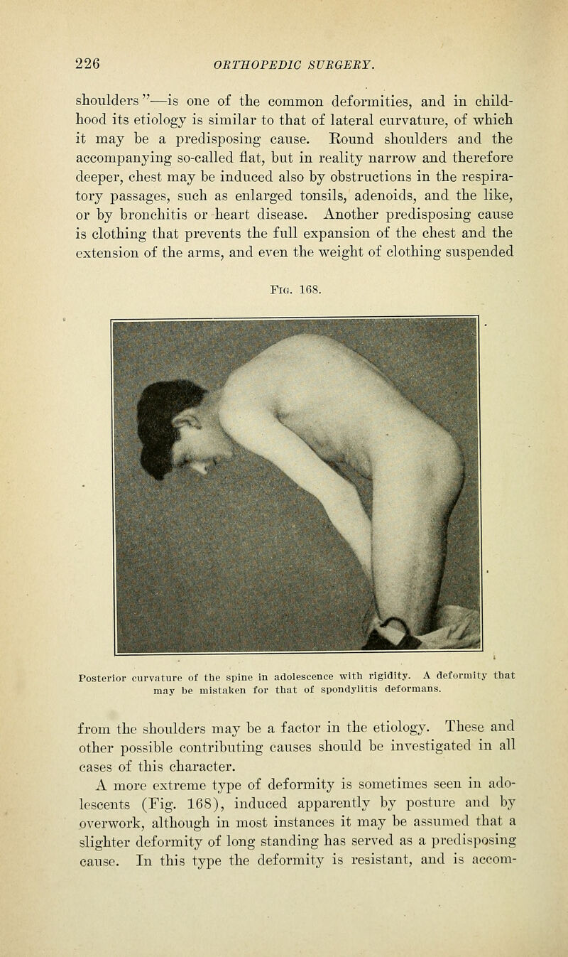 shoulders —is one of the common deformities, and in child- hood its etiology is similar to that of lateral curvature, of which it may be a predisposing cause. Round shoulders and thie accompanying so-called flat, but in reality narrow and therefore deeper, chest may be induced also by obstructions in the respira- tory passages, such as enlarged tonsils, adenoids, and the like, or by bronchitis or heart disease. Another predisposing cause is clothing that prevents the full expansion of the chest and the extension of the arms, and even the weight of clothing suspended Fig. 168. Posterior curvature of the spine in adolescence with rigidity. A deformity that may be mistalten for that of spondylitis deformans. from the shoulders may be a factor in the etiology. These and other possible contributing causes should be investigated in all cases of this character. A more extreme type of deformity is sometimes seen in ado- lescents (Fig. 168), induced apparently by posture and by overwork, although in most instances it may be assumed that a slighter deformity of long standing has served as a predisposing cause. In this type the deformity is resistant, and is accom-