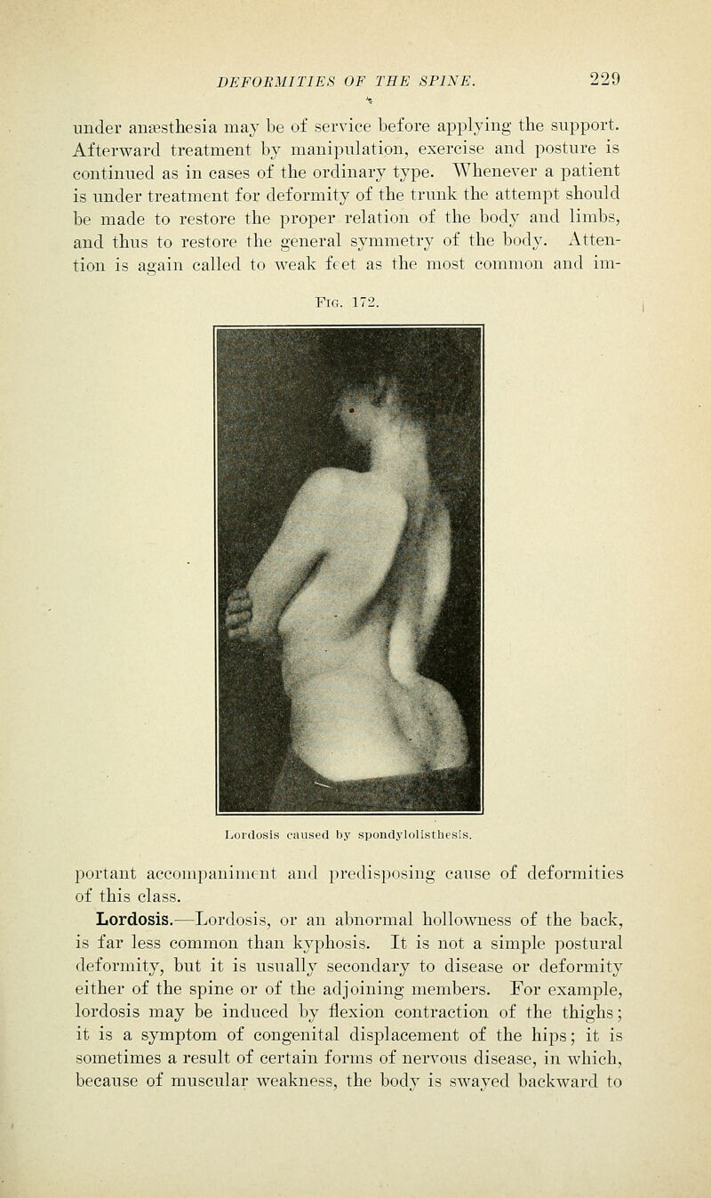 under ansesthesia may be of service before applying the support. Afterward treatment by manipulation, exercise and posture is continued as in cases of the ordinary type. Whenever a patient is imder treatment for deformity of the trunk the attempt should be made to restore the proper relation of the body and limbs, and thus to restore the general symmetry of the body. Atten- tion is again called to weak feet as the most common and im- FlG. 172. Lordosis caused by spondylolisthesis. portant accompaniment and predisposing cause of deformities of this class. Lordosis.—Lordosis, or an abnormal hollowness of the back, is far less common than kyphosis. It is not a simple postural deformity, but it is usually secondary to disease or deformity either of the spine or of the adjoining members. For example, lordosis may be induced by flexion contraction of the thighs; it is a symptom of congenital displacement of the hips; it is sometimes a result of certain forms of nervous disease, in which, because of muscular weakness, the body is swayed backward to