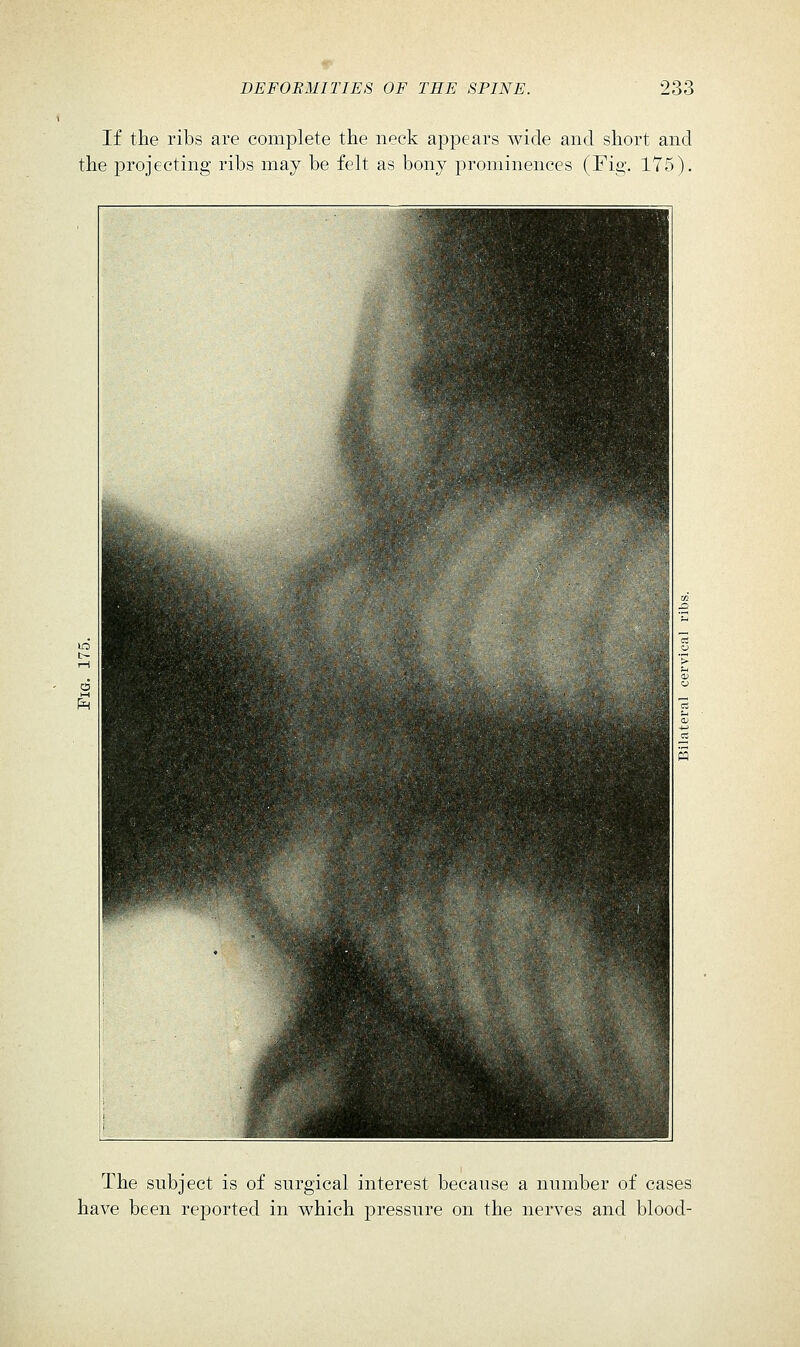 If the ribs are complete the neck appears wide and short and the projecting ribs may be felt as bony prominences (Fig. 175). The subject is of surgical interest because a number of cases have been reported in which pressure on the nerves and blood-