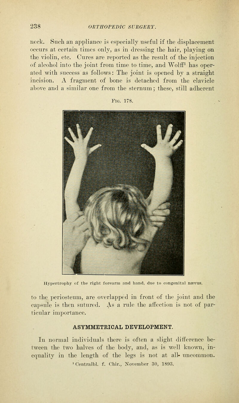 neck. Such an appliance is especially useful if the displacement occurs at certain times only, as in dressing the hair, playing on the violin, etc. Cures are reported as the result of the injection of alcohol into the joint from time to time, and Wolffs has oper- ated with success as follows: The joint is opened by a straight incision. A fragment of bone is detached from the clavicle above and a similar one from the sternum; these, still adherent Fig. 178. Hypertropliy of the right forearm and hand, due to congenital nfevus. to the periosteum, are overlapped in front of the joint and the capsule is then sutured. As a rule the affection is not of par- ticular importance. ASYMMETRICAL DEVELOPMENT. In normal individuals there is often a slight difference be- tween the two halves of the body, and, as is well known, in- equality in the length of the legs is not at all- uncommon. ^Centralbl. f. Chir., November 30, 1893.