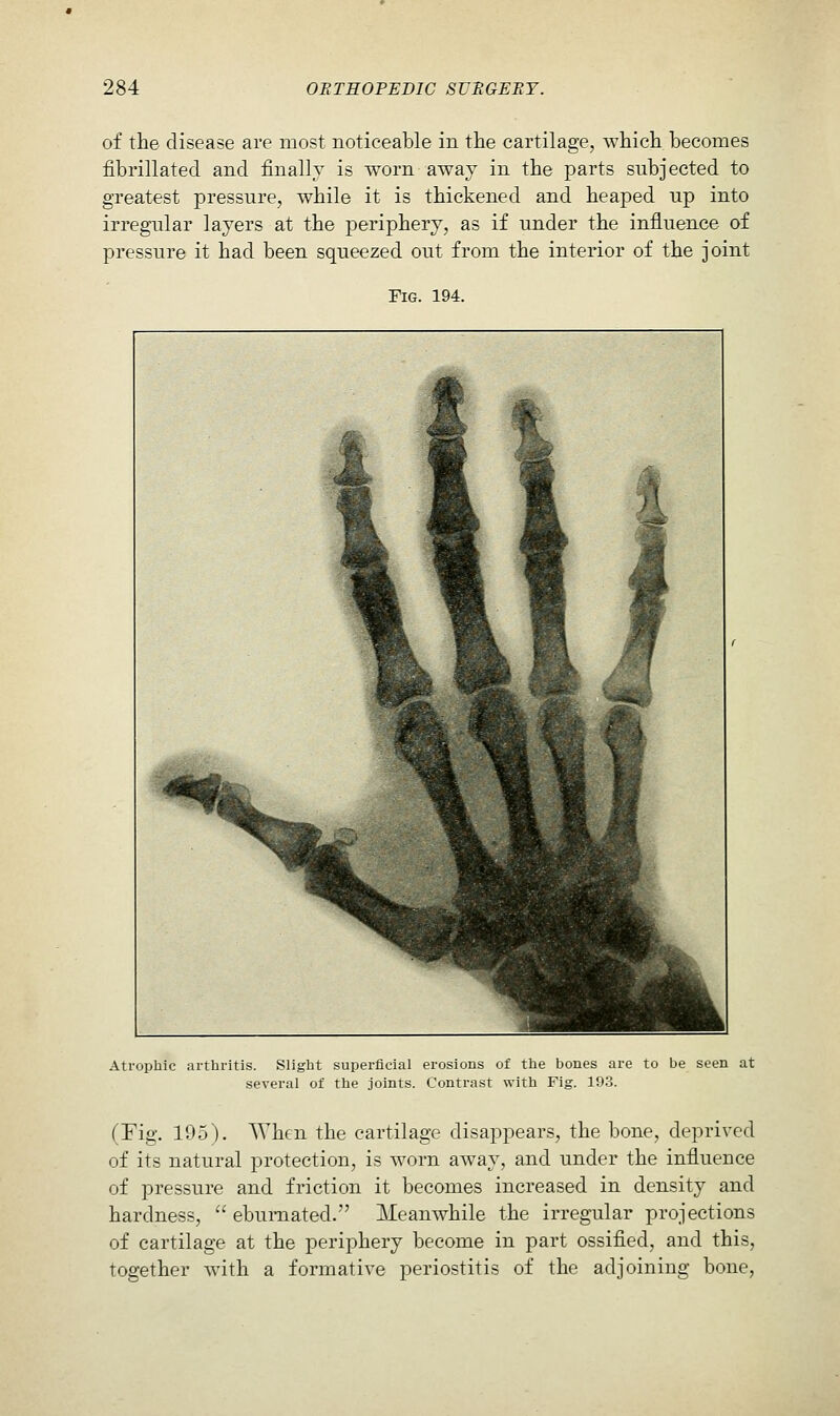 of the disease are most noticeable in the cartilage, ^vhich becomes fibrillated and finally is worn away in the parts subjected to greatest pressure, while it is thickened and heaped up into irregular layers at the periphery, as if under the influence of pressure it had been squeezed out from the interior of the joint Fig. 194. Atrophic arthritis. Slight superficial erosions of the bones are to be seen at several of the joints. Contrast with Fig. 103. (Fig, 195). When the cartilage disappears, the bone, deprived of its natural protection, is worn away, and under the influence of pressure and friction it becomes increased in density and hardness,  ebumated. Meanwhile the irregular projections of cartilage at the periphery become in part ossified, and this, together with a formative periostitis of the adjoining bone.