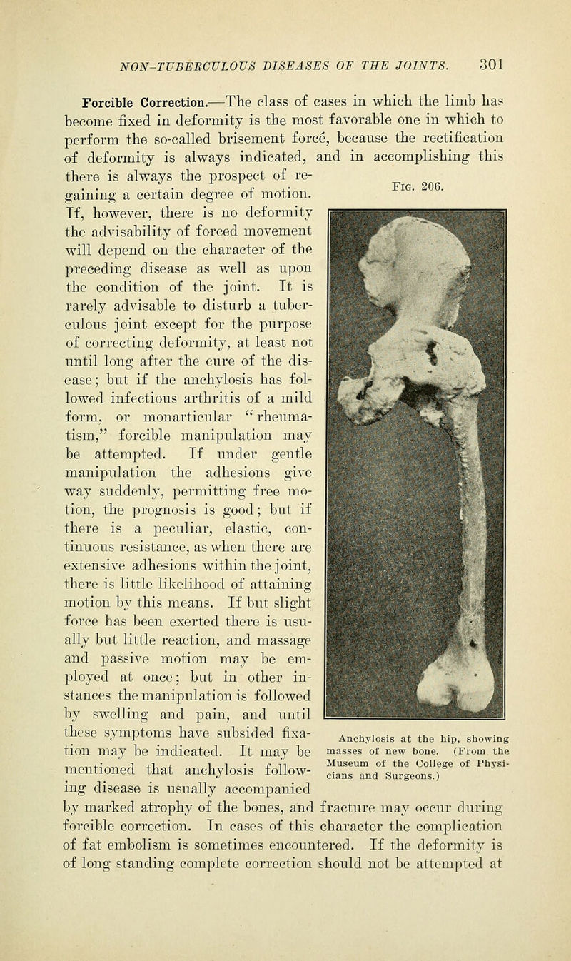 Fig. 206. Forcible Correction.—The class of cases in which the limb has become fixed in deformity is the most favorable one in which to perform the so-called brisement force, because the rectification of deformity is always indicated, and in accomplishing this there is always the prospect of re- gaining a certain degree of motion. If, however, there is no deformity the advisability of forced movement will depend on the character of the preceding disease as well as upon the condition of the joint. It is rarely advisable to disturb a tuber- culous joint except for the purpose of correcting deformity, at least not until long after the cure of the dis- ease ; but if the anchylosis has fol- lowed infectious arthritis of a mild form, or monarticular  rheuma- tism, forcible manipulation may be attempted. If under gentle manipulation the adhesions give way suddenly, permitting free mo- tion, the progTiosis is good; but if there is a peculiar, elastic, con- tinuous resistance, as when there are extensive adhesions within the joint, there is little likelihood of attaining motion by this means. If but slight force has been exerted there is usu- ally but little reaction, and massage and passive motion may be em- ployed at once; but in other in- stances the manipulation is followed by swelling and pain, and until these symptoms have subsided fixa- tion may be indicated. It may be mentioned that anchylosis follow- ing disease is usually accompanied by marked atrophy of the bones, and fracture may occur during forcible correction. In cases of this character the complication of fat embolism is sometimes encountered. If the deformity is of long standing complete correction should not be attempted at Anchylosis at the hip, showing masses of new bone. (From the Museum of the College of Physi- cians and Surgeons.)