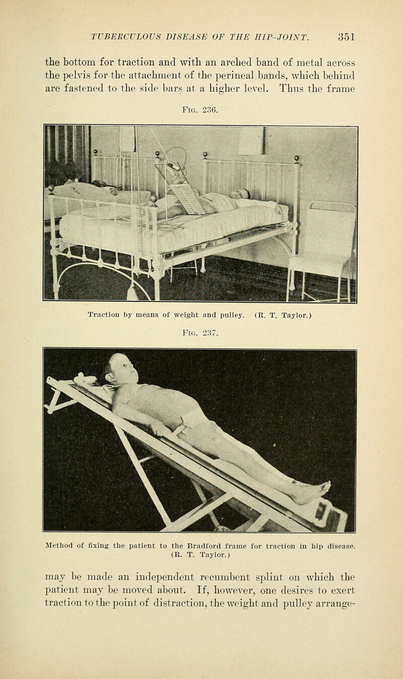 the bottom for traction and with an arched band of metal across the pelvis for the attachment of the perineal bands, which behind are fastened to the side bars at a higher level. Thus the frame Fig. 236. Traction by means of weight and pulley. (R. T. Taylor.) Fig. 237. Method of fixing the patient to the Bradford frame for traction in hip disease. (R. T. Taylor.) may be made an independent recumbent splint on which the patient may be moved about. If, however, one desires to exert traction to the point of distraction, the weight and pulley arrange-